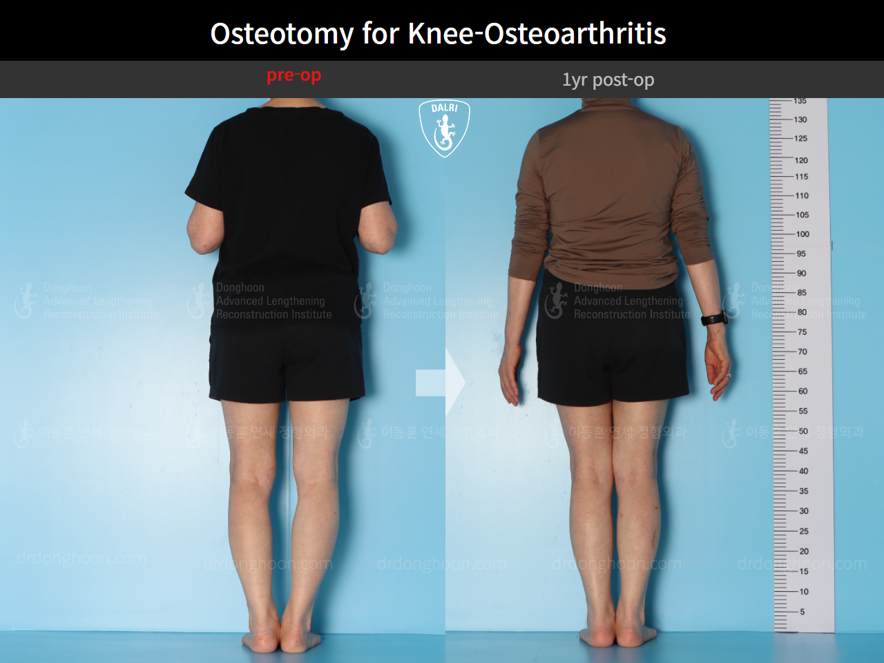 Before and after osteotomy for knee osteoarthritis, case 16893966, image 3, Dr. Donghoon institute (DALRI)