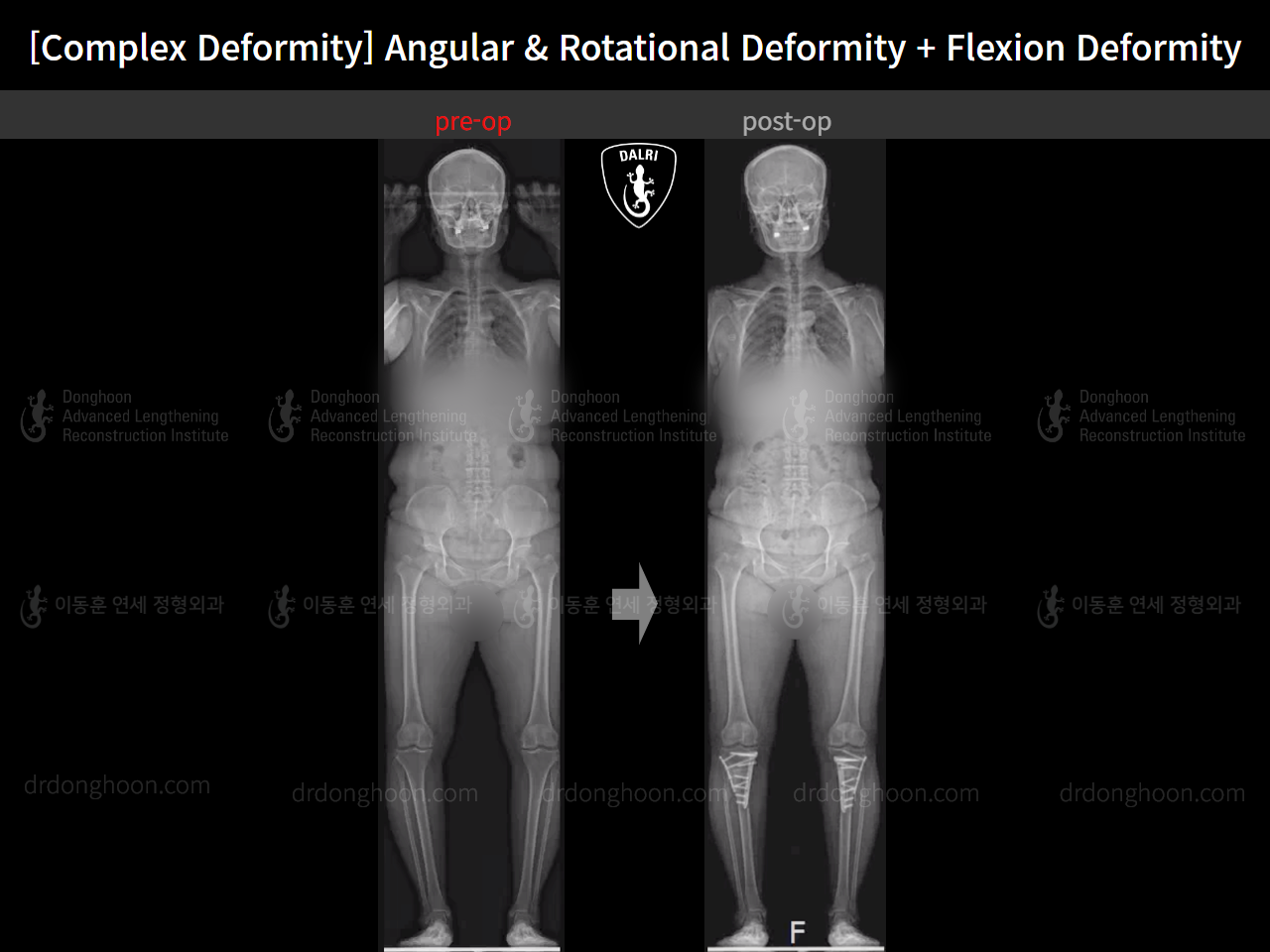 Before and after osteotomy for knee osteoarthritis, case 16781349, image 13, Dr. Donghoon institute (DALRI)