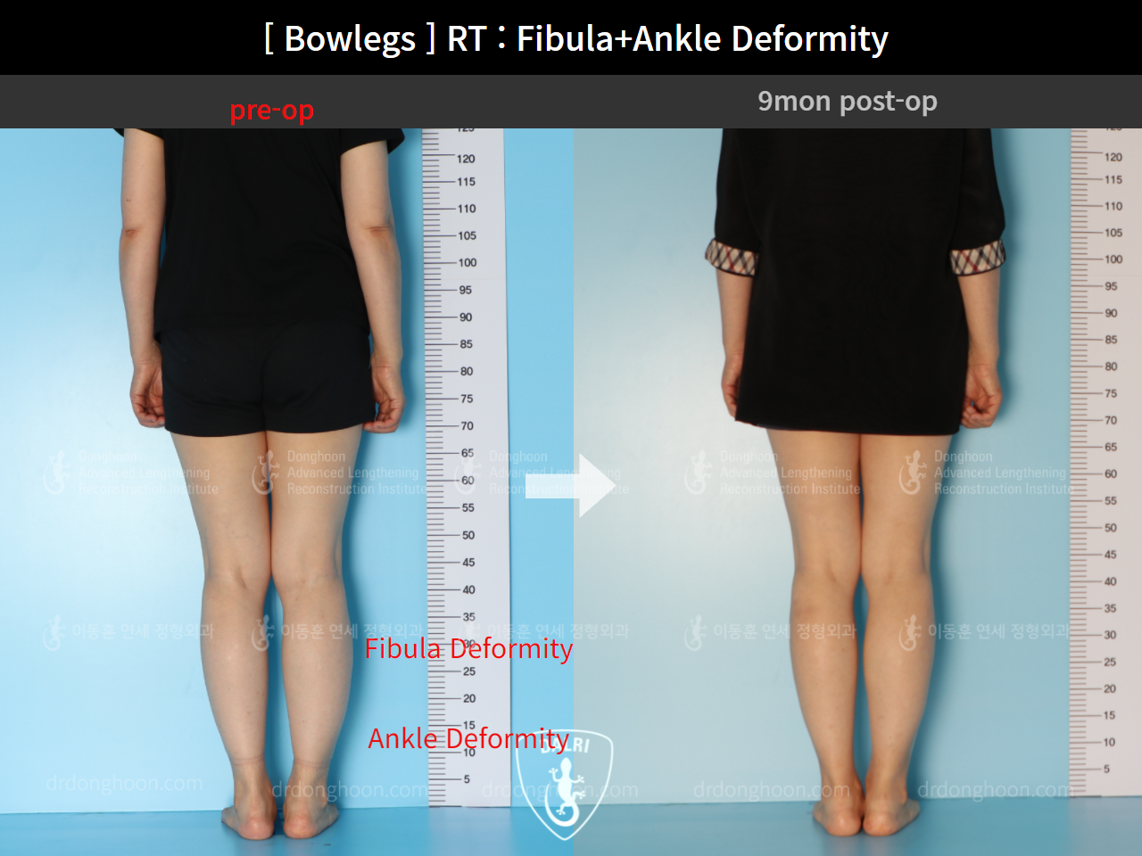 Before and after adult bowlegs, case 9119520, image 3, Dr. Donghoon institute (DALRI)