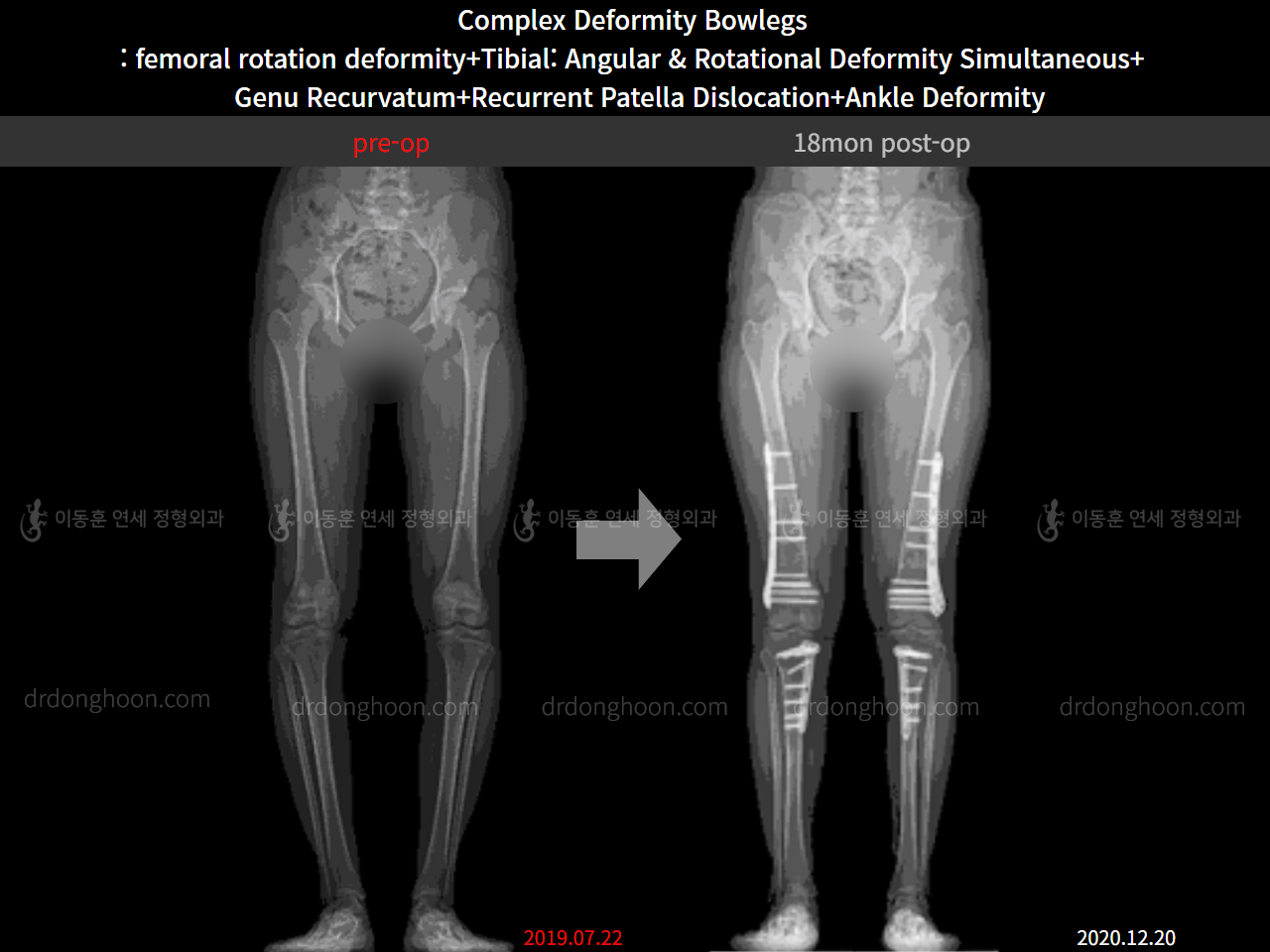 Before and after adult bowlegs, case 11243996, image 7, Dr. Donghoon institute (DALRI)