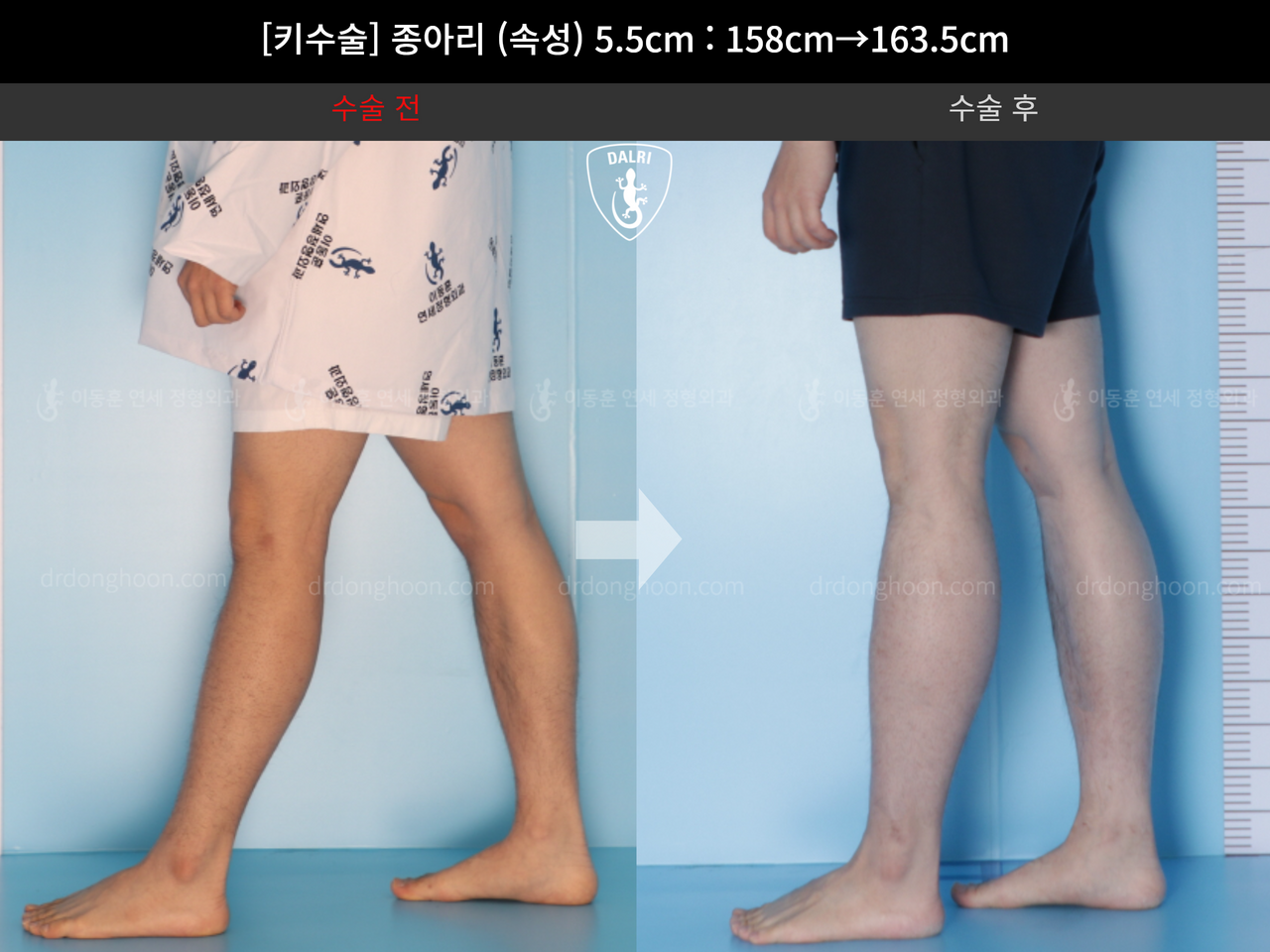 Before and after cll lon, case 4577764, image 8, Dr. Donghoon institute (DALRI)