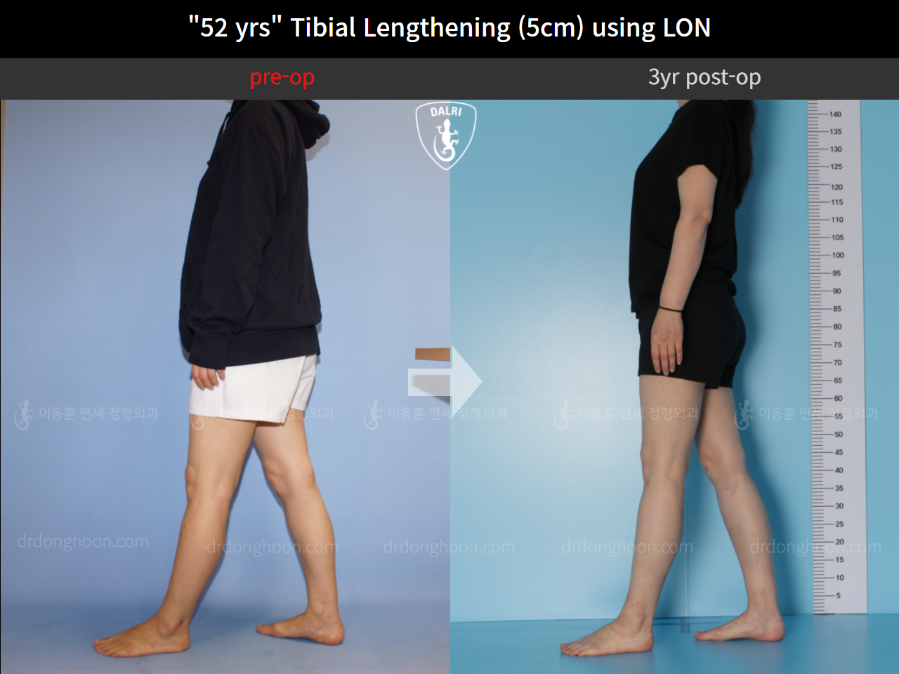Before and after cll lon, case 9977769, image 3, Dr. Donghoon institute (DALRI)