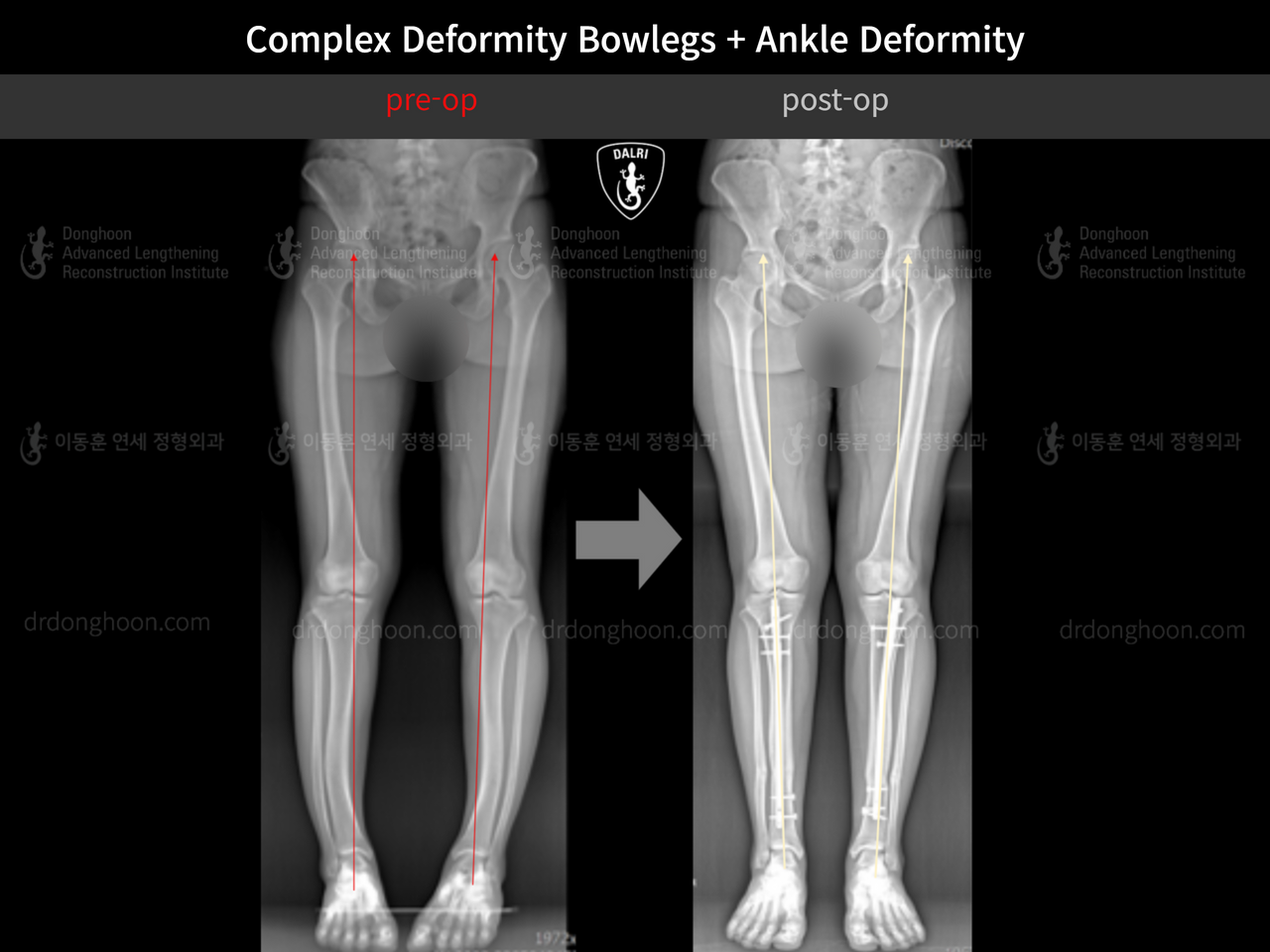 Before and after foot & ankle deformity, case 13215063, image 4, Dr. Donghoon institute (DALRI)