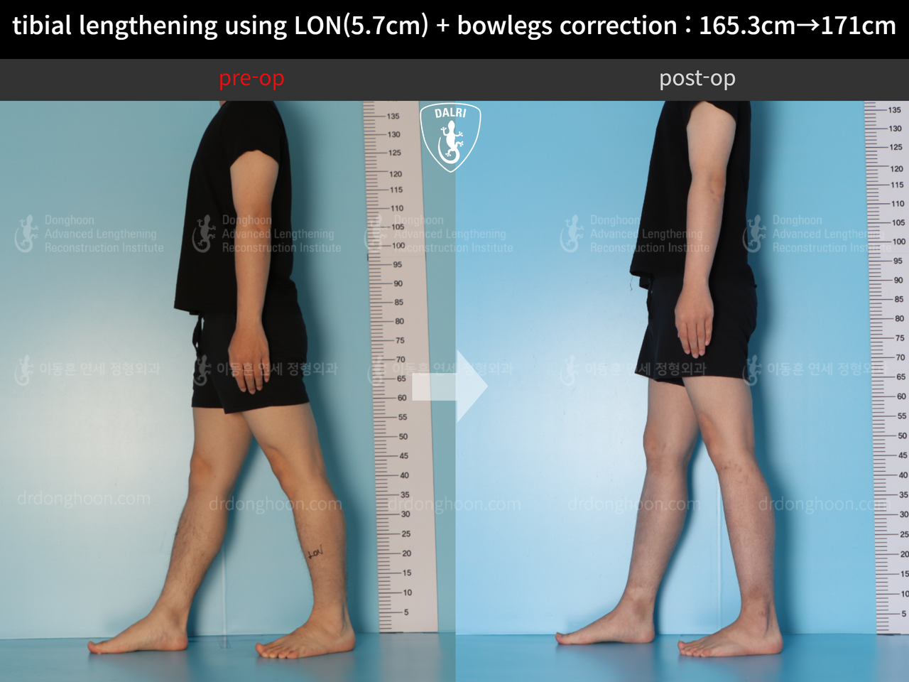 Before and after cll lon, case 12679171, image 3, Dr. Donghoon institute (DALRI)