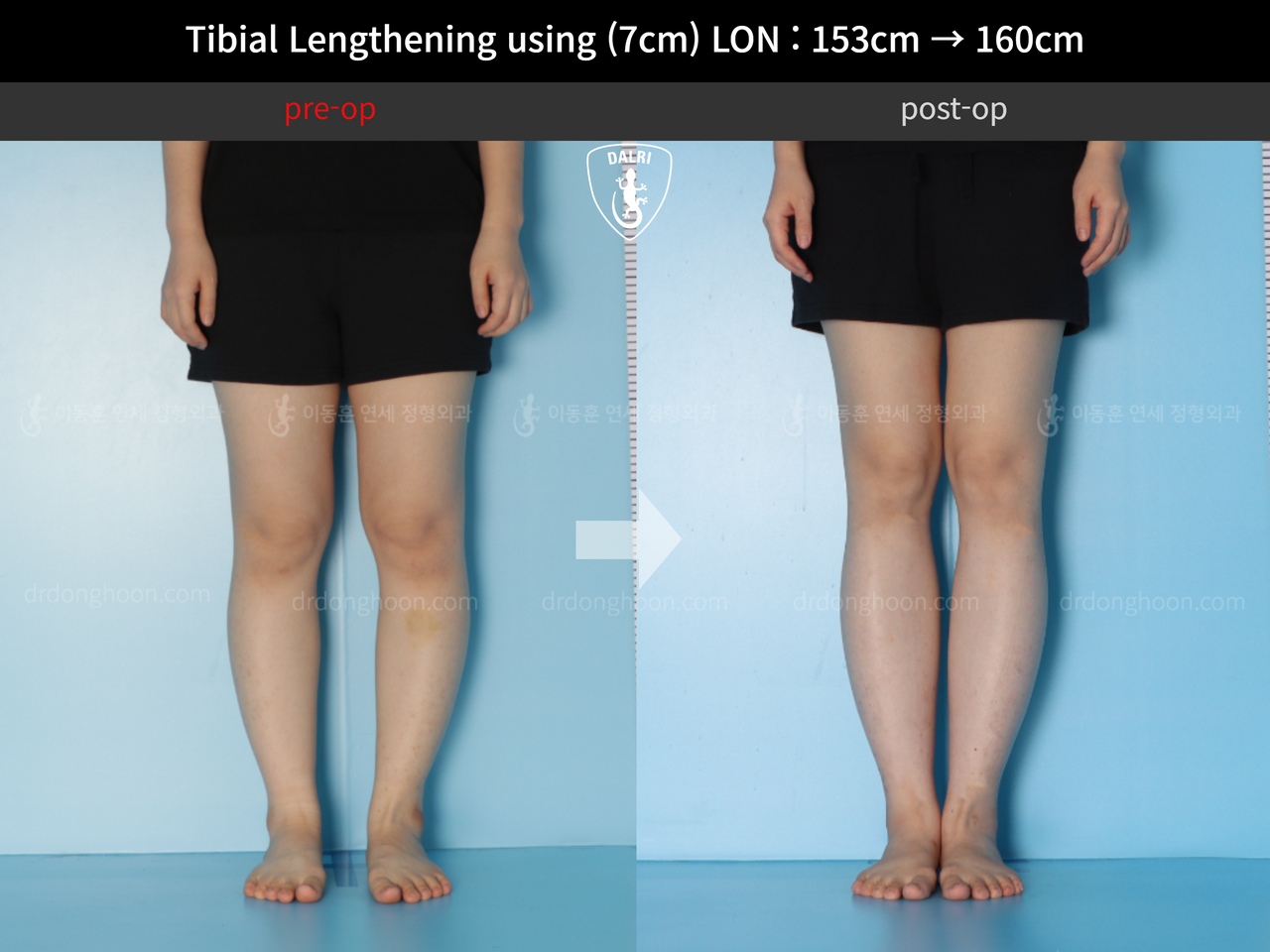 Before and after cll lon, case 12679165, image 3, Dr. Donghoon institute (DALRI)