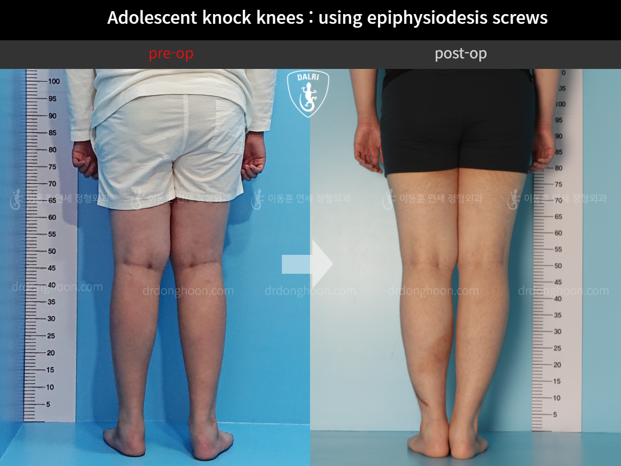 Before and after paediatric & adolescent knock knees, case 4310914, image 3, Dr. Donghoon institute (DALRI)