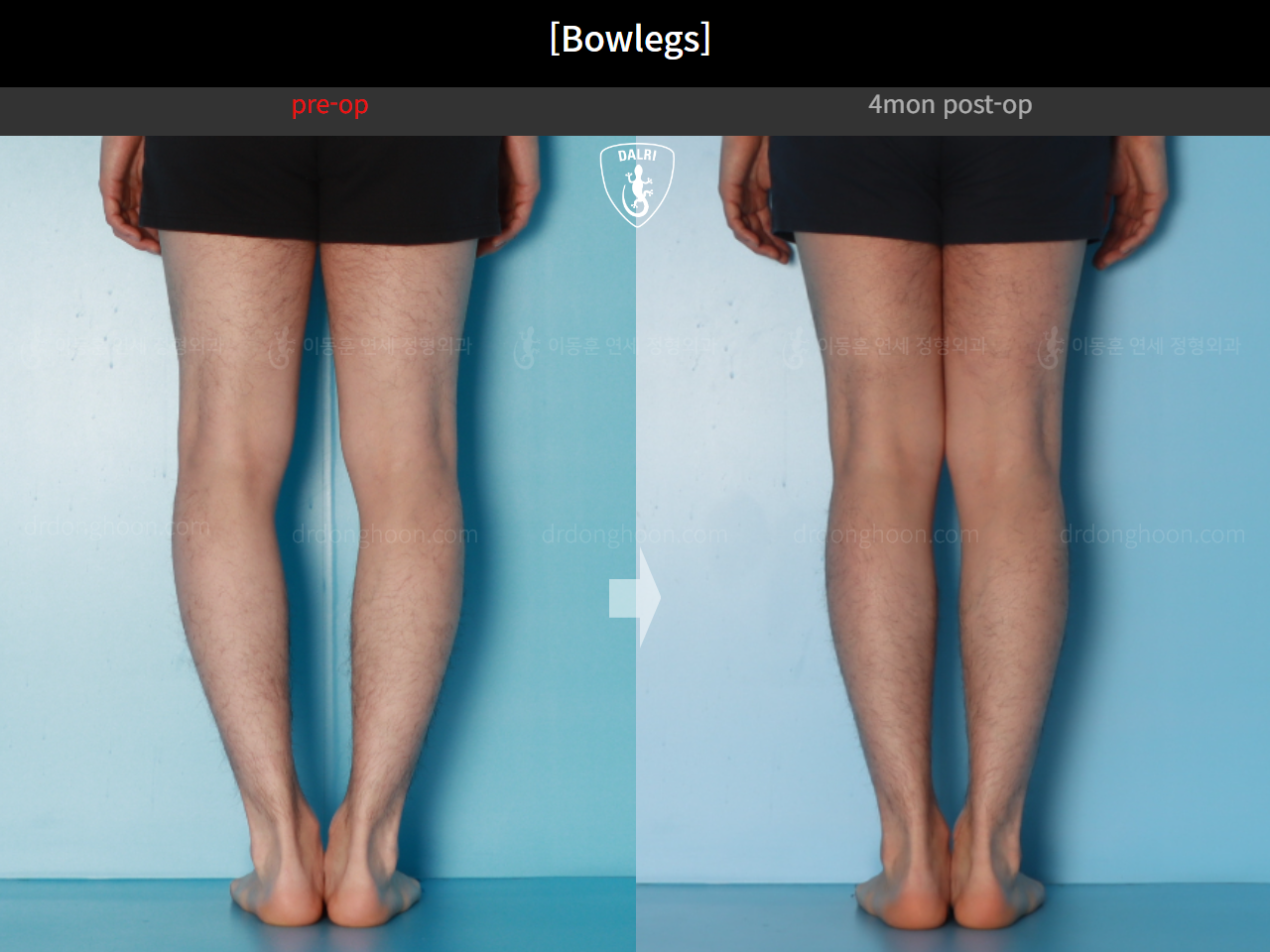 Before and after adult bowlegs, case 21098909, image 9, Dr. Donghoon institute (DALRI)