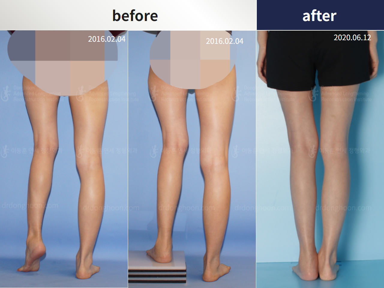 Before and after adult lld, case 4393185, image 2, Dr. Donghoon institute (DALRI)