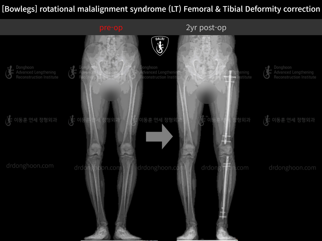 Before and after adult bowlegs, case 13266718, image 11, Dr. Donghoon institute (DALRI)