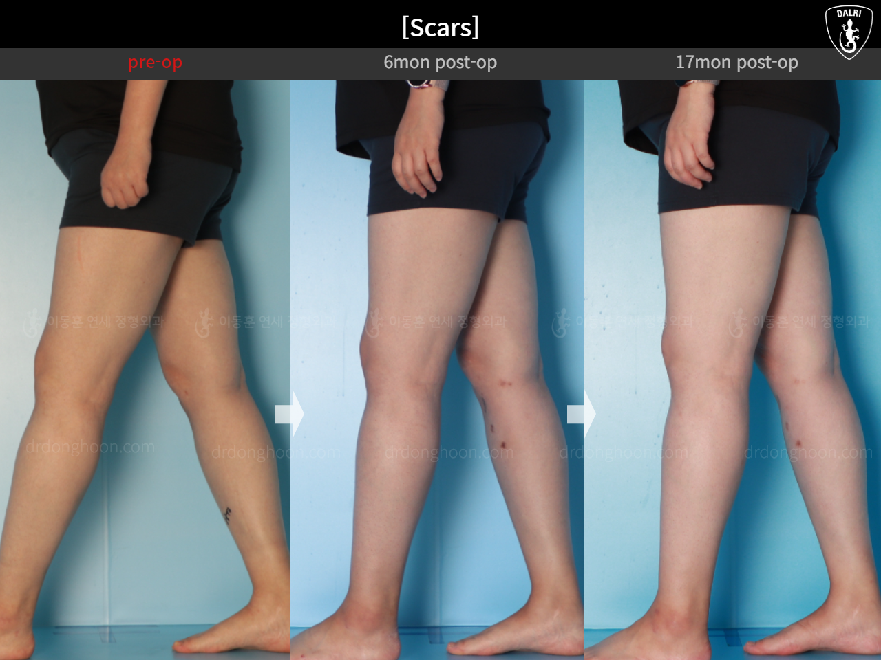 Before and after osteotomy for knee osteoarthritis, case 15944917, image 9, Dr. Donghoon institute (DALRI)