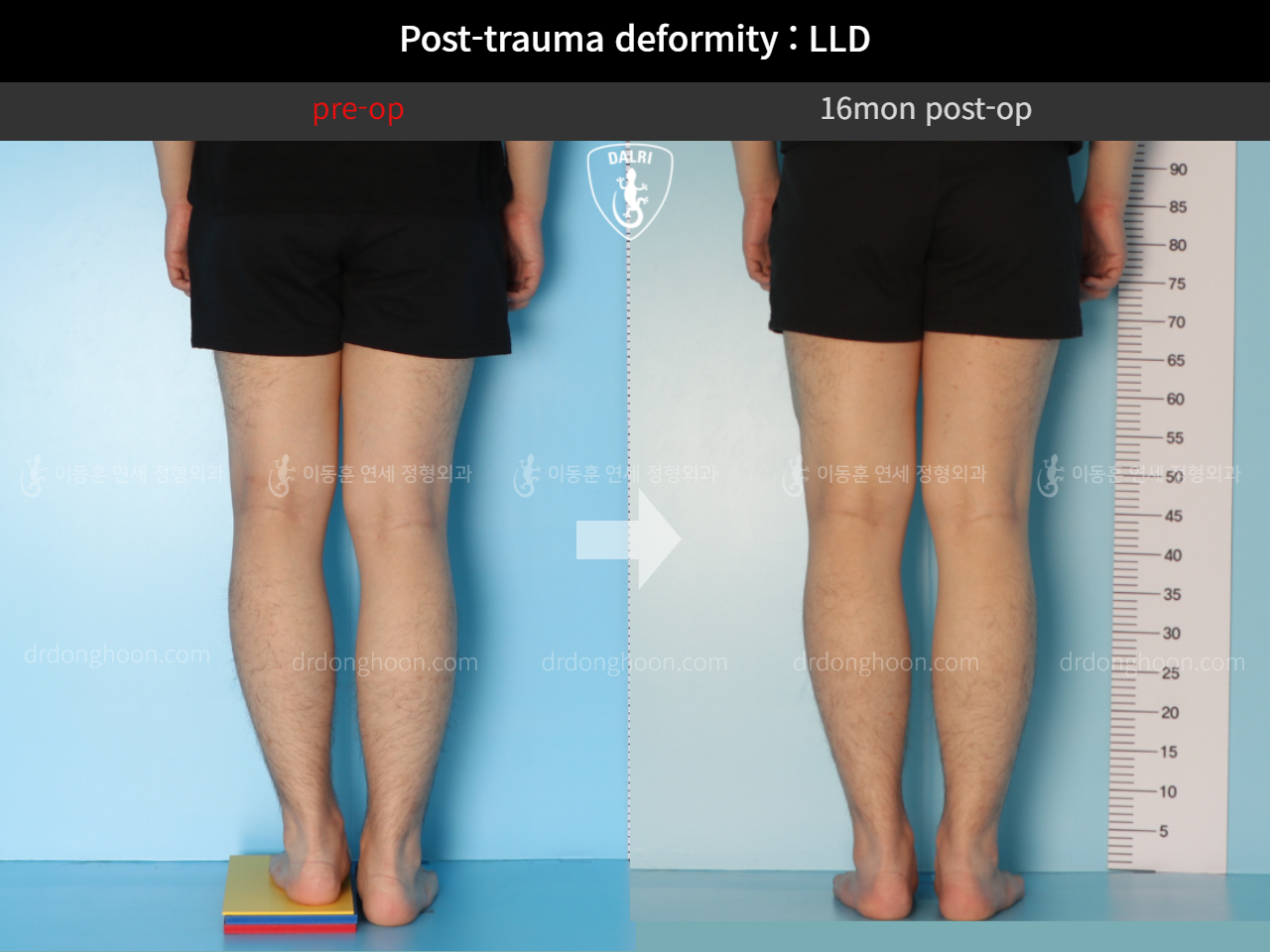 Before and after adult lld, case 11086886, image 5, Dr. Donghoon institute (DALRI)