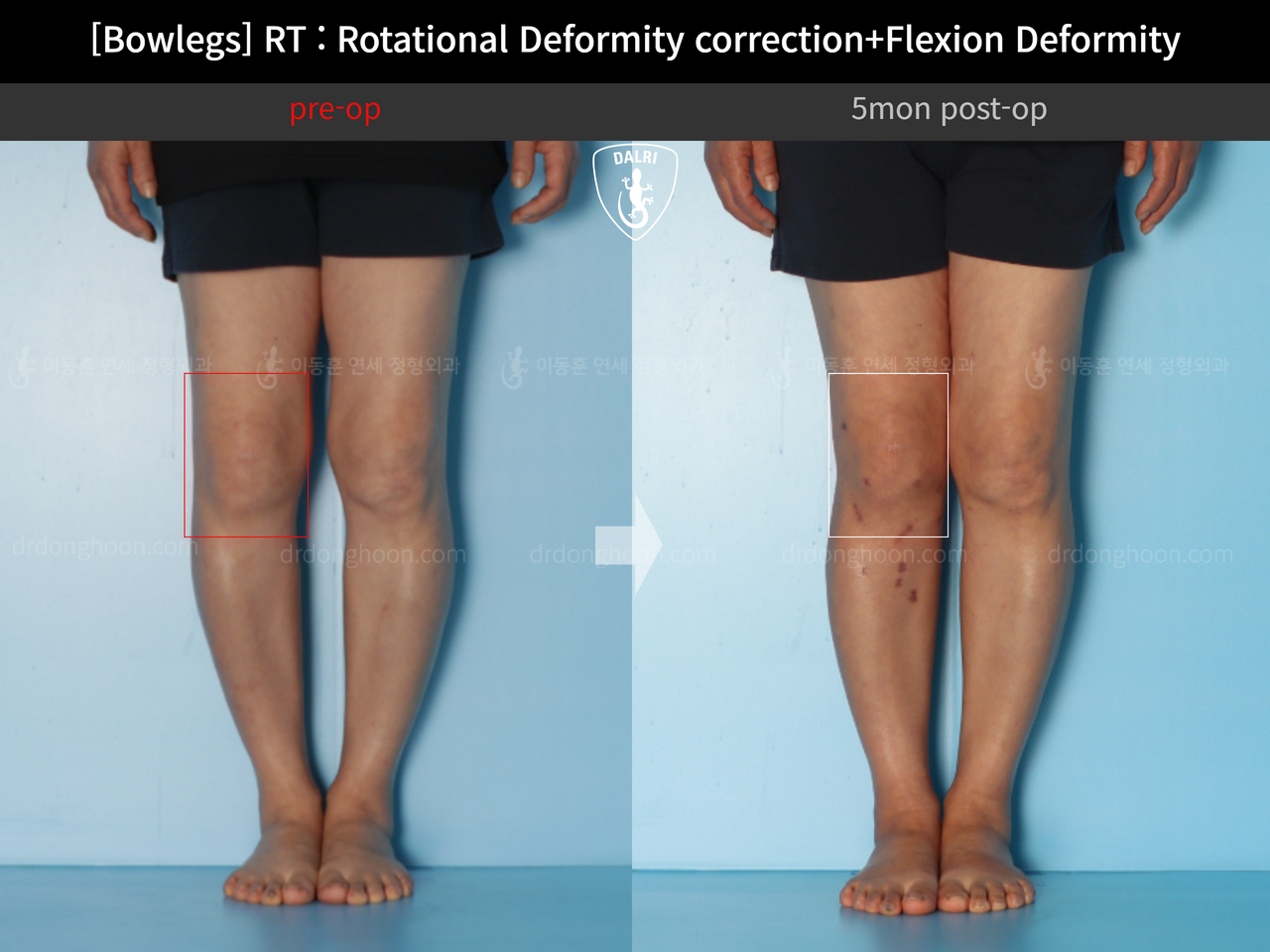 Before and after adult bowlegs, case 13668670, image 4, Dr. Donghoon institute (DALRI)