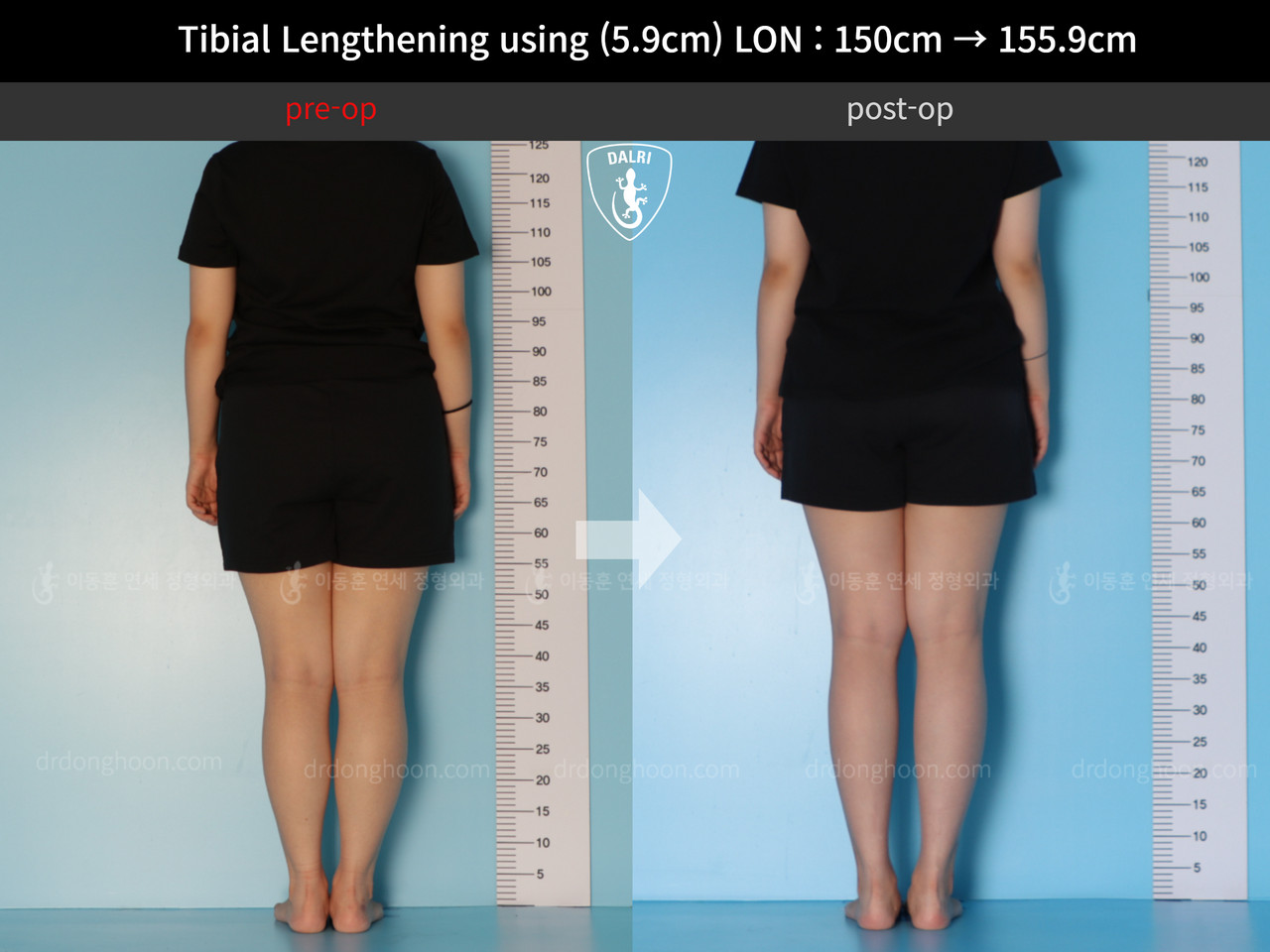 Before and after cll lon, case 12207071, image 2, Dr. Donghoon institute (DALRI)