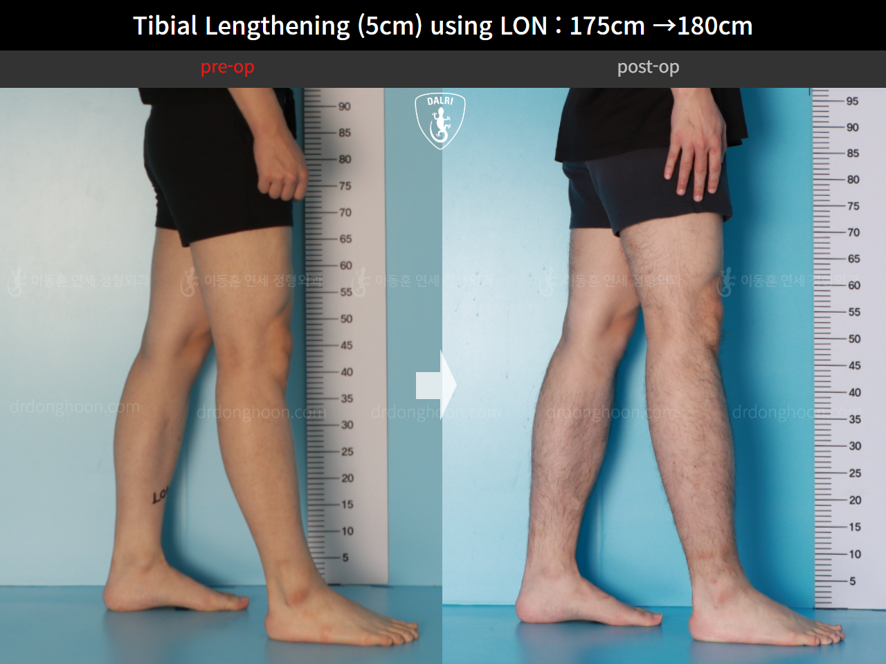 Before and after cll lon, case 15931051, image 7, Dr. Donghoon institute (DALRI)