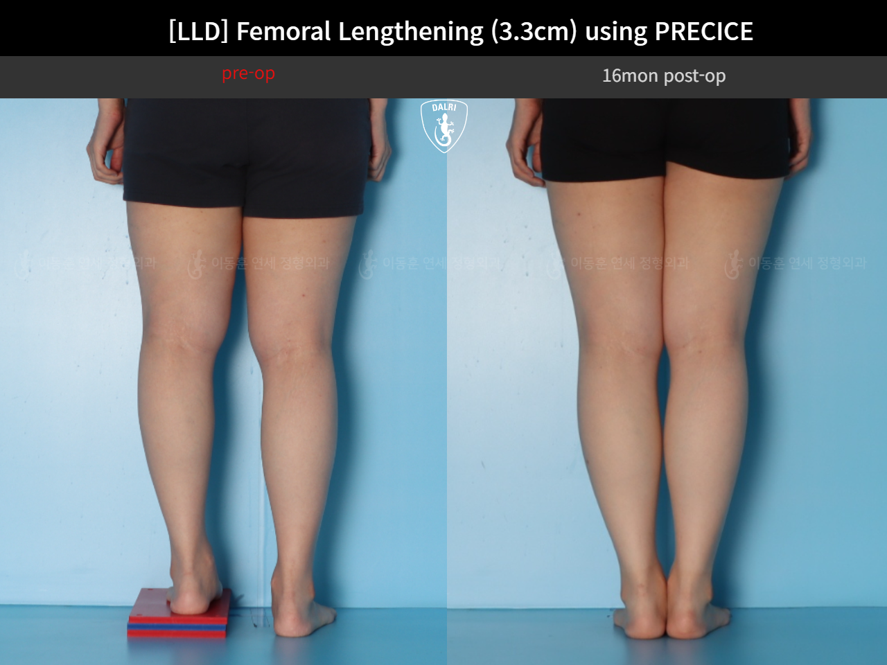 Before and after adult lld, case 125639660, image 6, Dr. Donghoon institute (DALRI)
