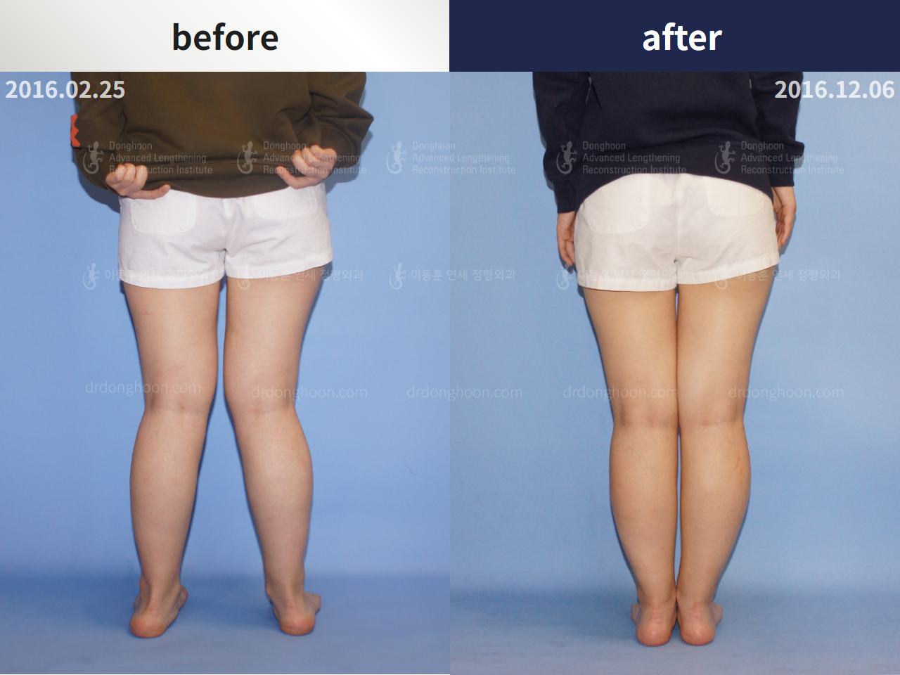 Before and after congenital condition, case 4304666, image 2, Dr. Donghoon institute (DALRI)