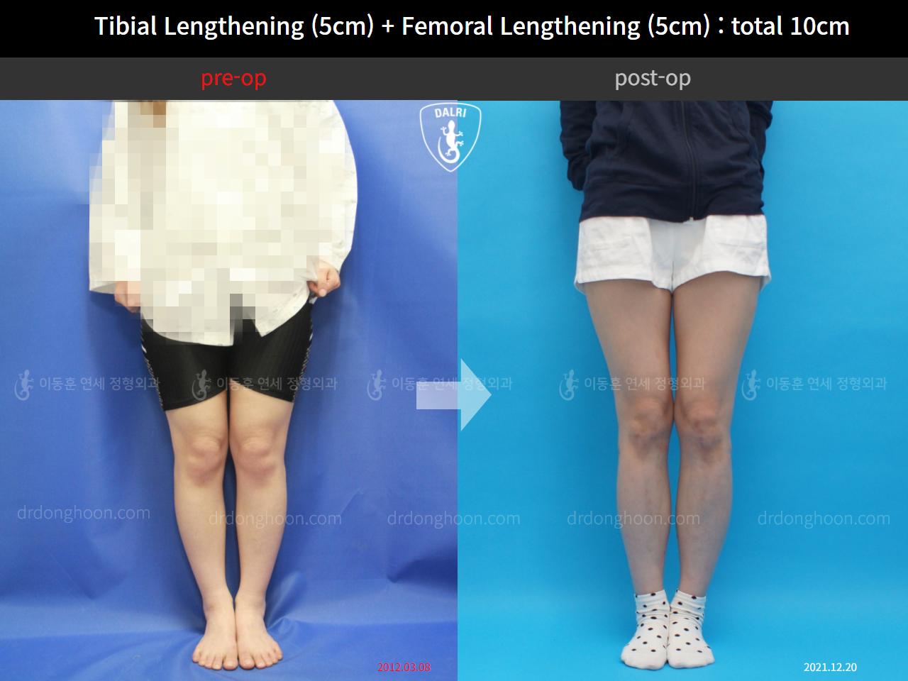 Before and after cll lon, case 11035009, image 2, Dr. Donghoon institute (DALRI)