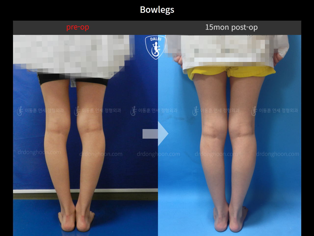 Before and after adult bowlegs, case 4310970, image 5, Dr. Donghoon institute (DALRI)