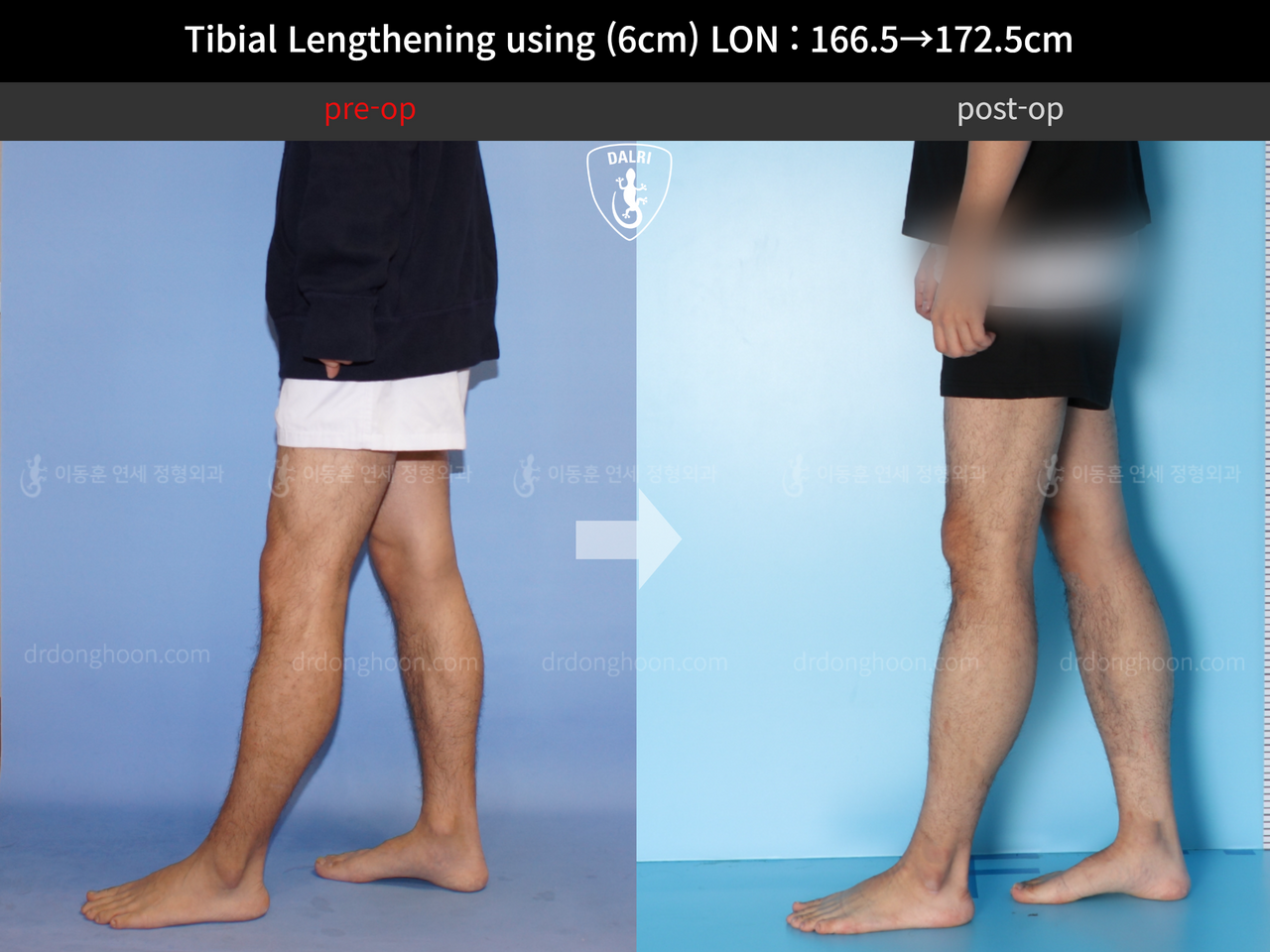 Before and after cll lon, case 11980239, image 8, Dr. Donghoon institute (DALRI)