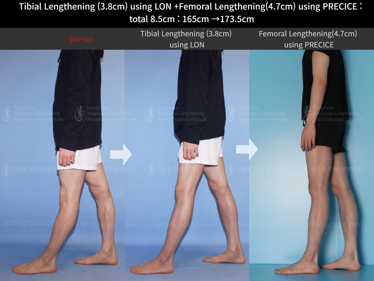 Before and after cll precice, case 4576980, image 4, Dr. Donghoon institute (DALRI)