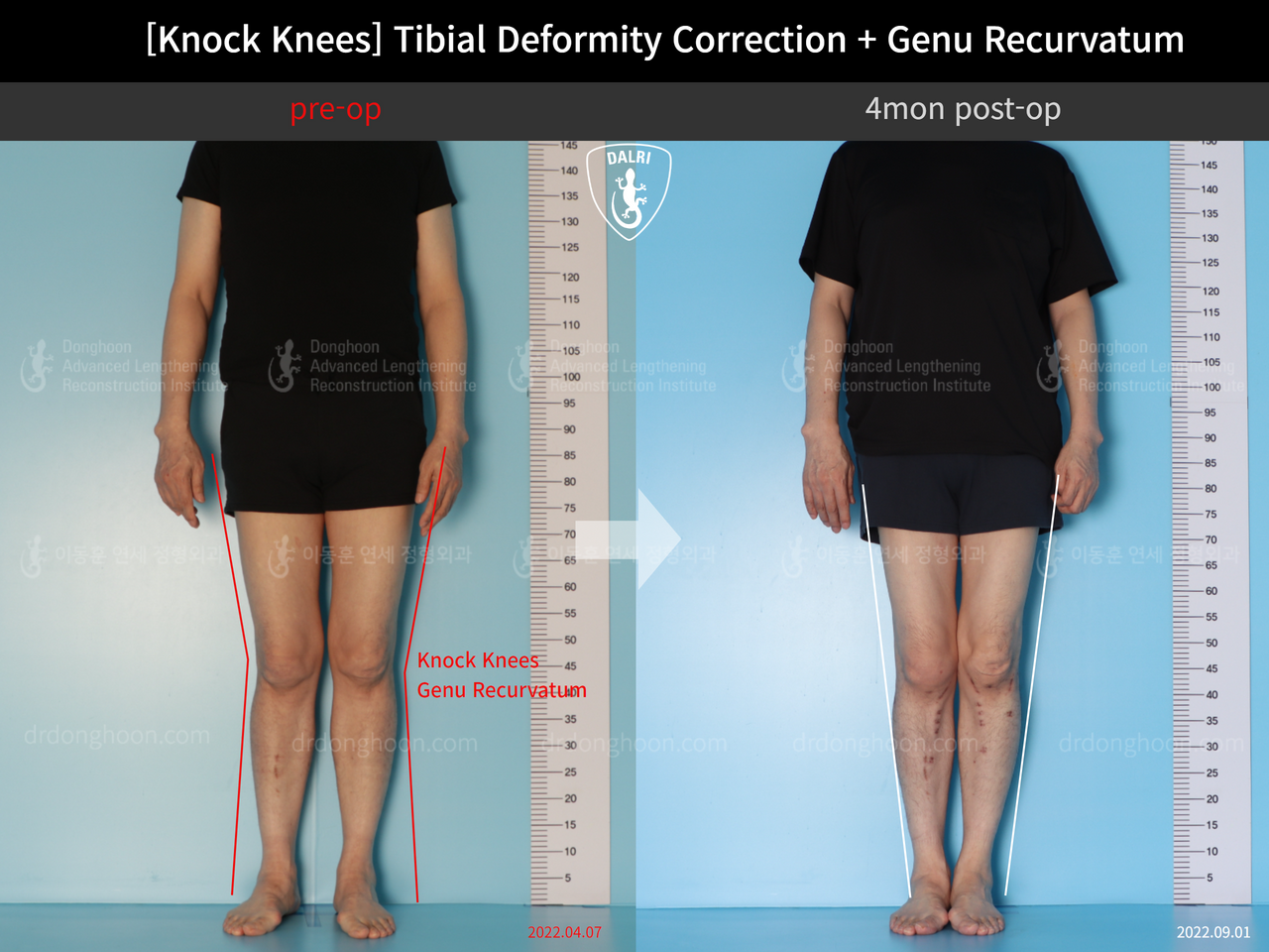 Before and after adult knock knees, case 12846255, image 1, Dr. Donghoon institute (DALRI)