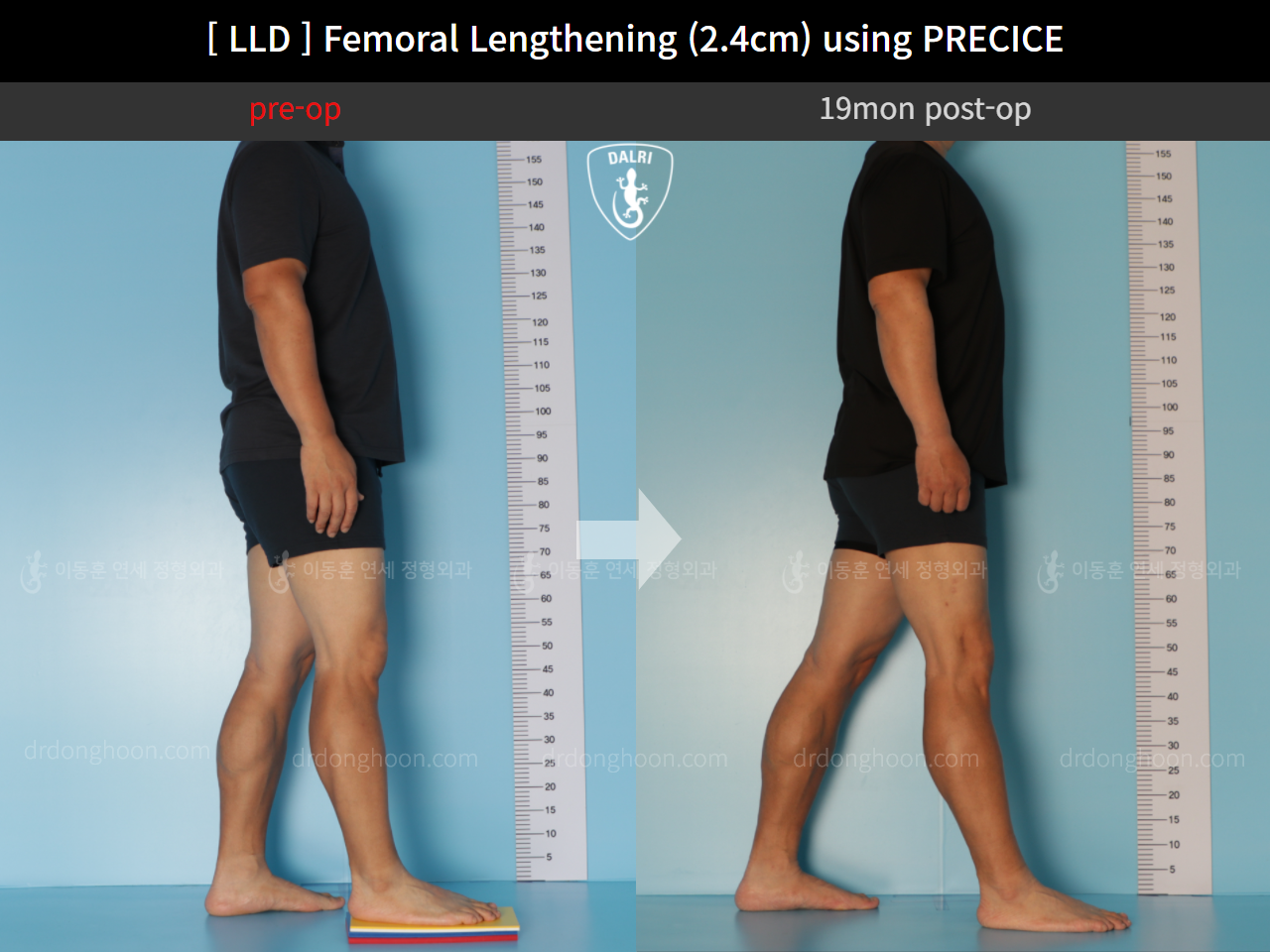 Before and after adult lld, case 10990486, image 3, Dr. Donghoon institute (DALRI)