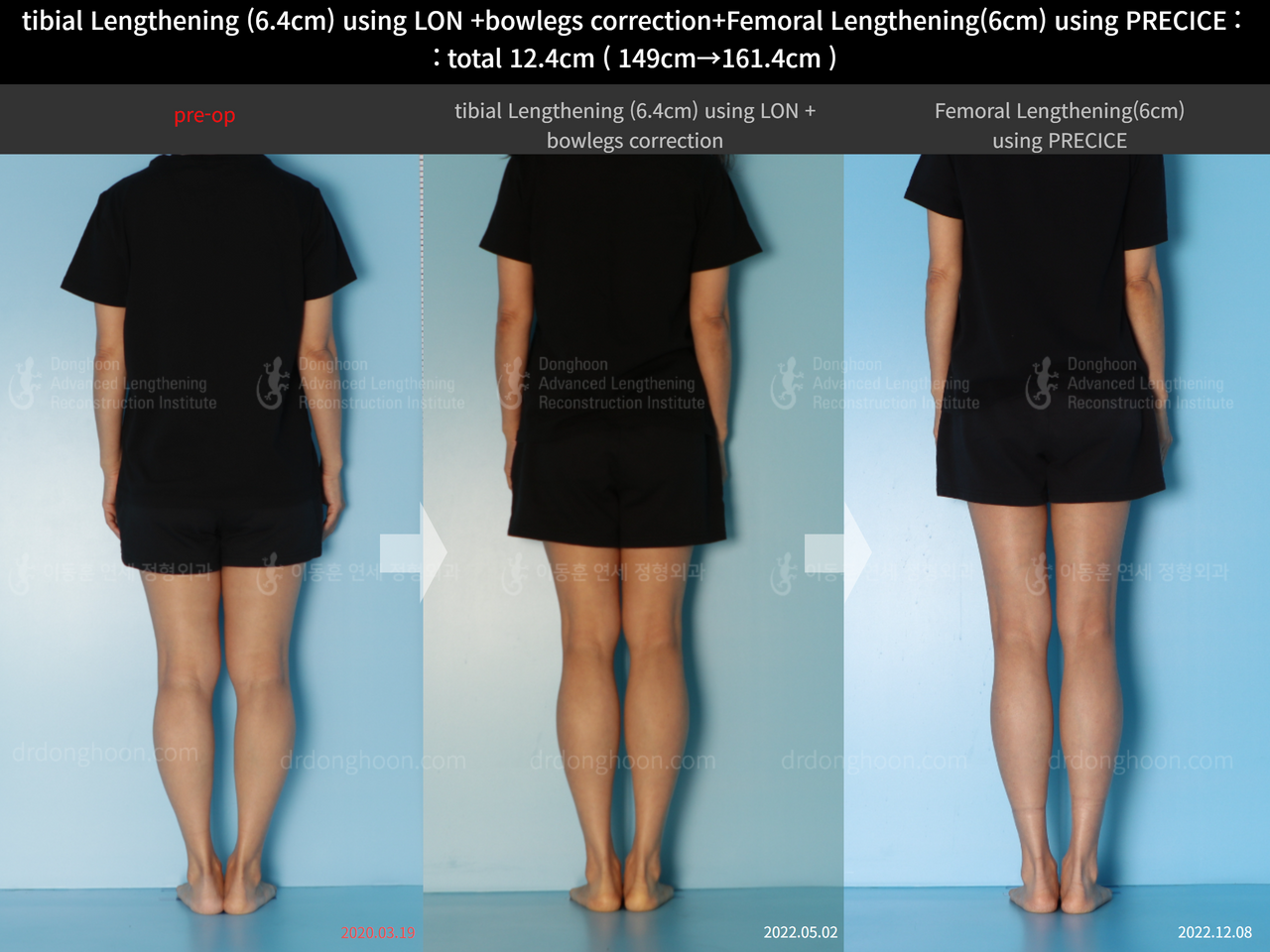 Before and after cll precice, case 13696246, image 2, Dr. Donghoon institute (DALRI)