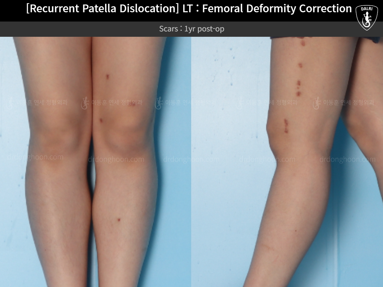 Before and after recurrent patella dislocation, case 15125370, image 5, Dr. Donghoon institute (DALRI)
