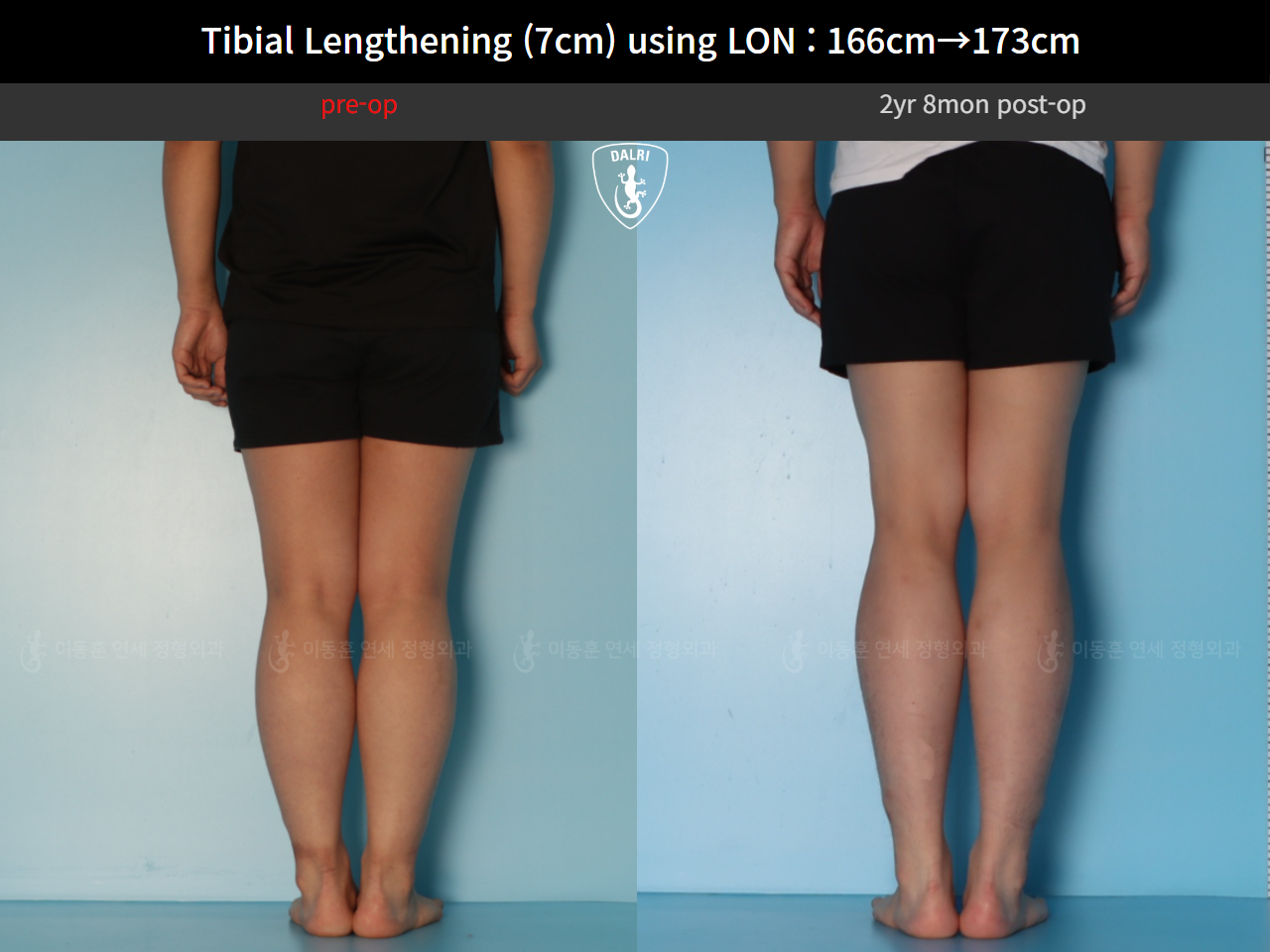 Before and after cll lon, case 127679780, image 6, Dr. Donghoon institute (DALRI)