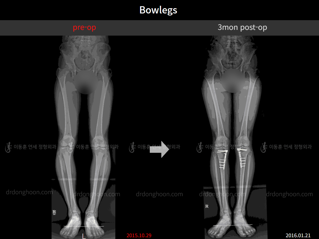 Before and after adult bowlegs, case 4311351, image 5, Dr. Donghoon institute (DALRI)