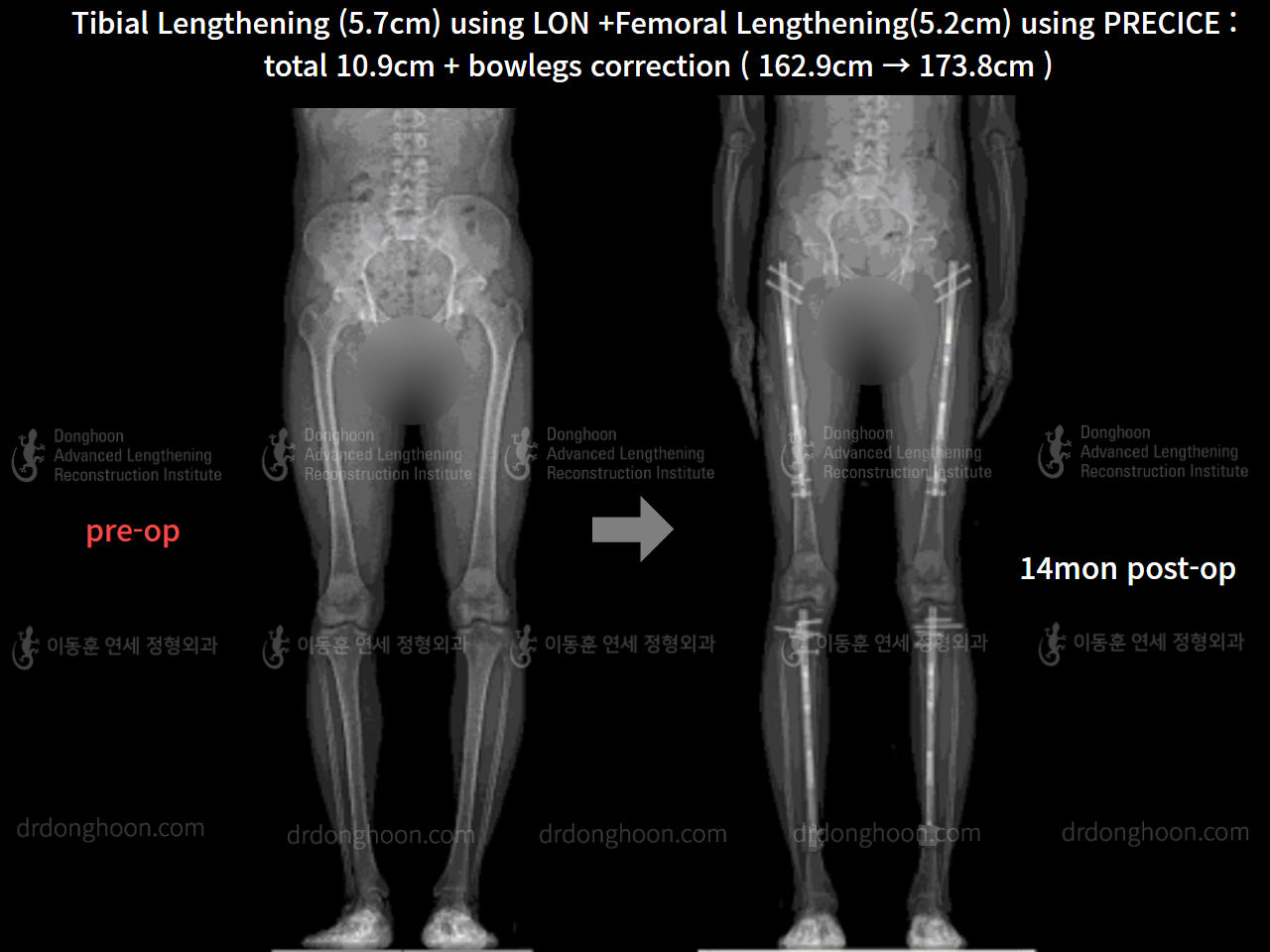 Before and after cll + deformity correction, case 8417894, image 9, Dr. Donghoon institute (DALRI)