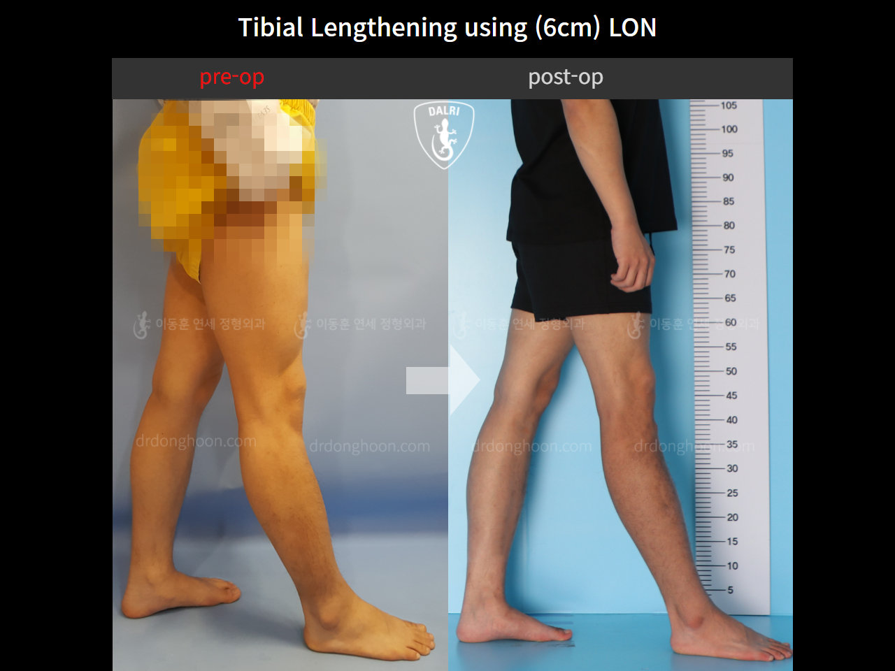 Before and after cll lon, case 11087271, image 7, Dr. Donghoon institute (DALRI)
