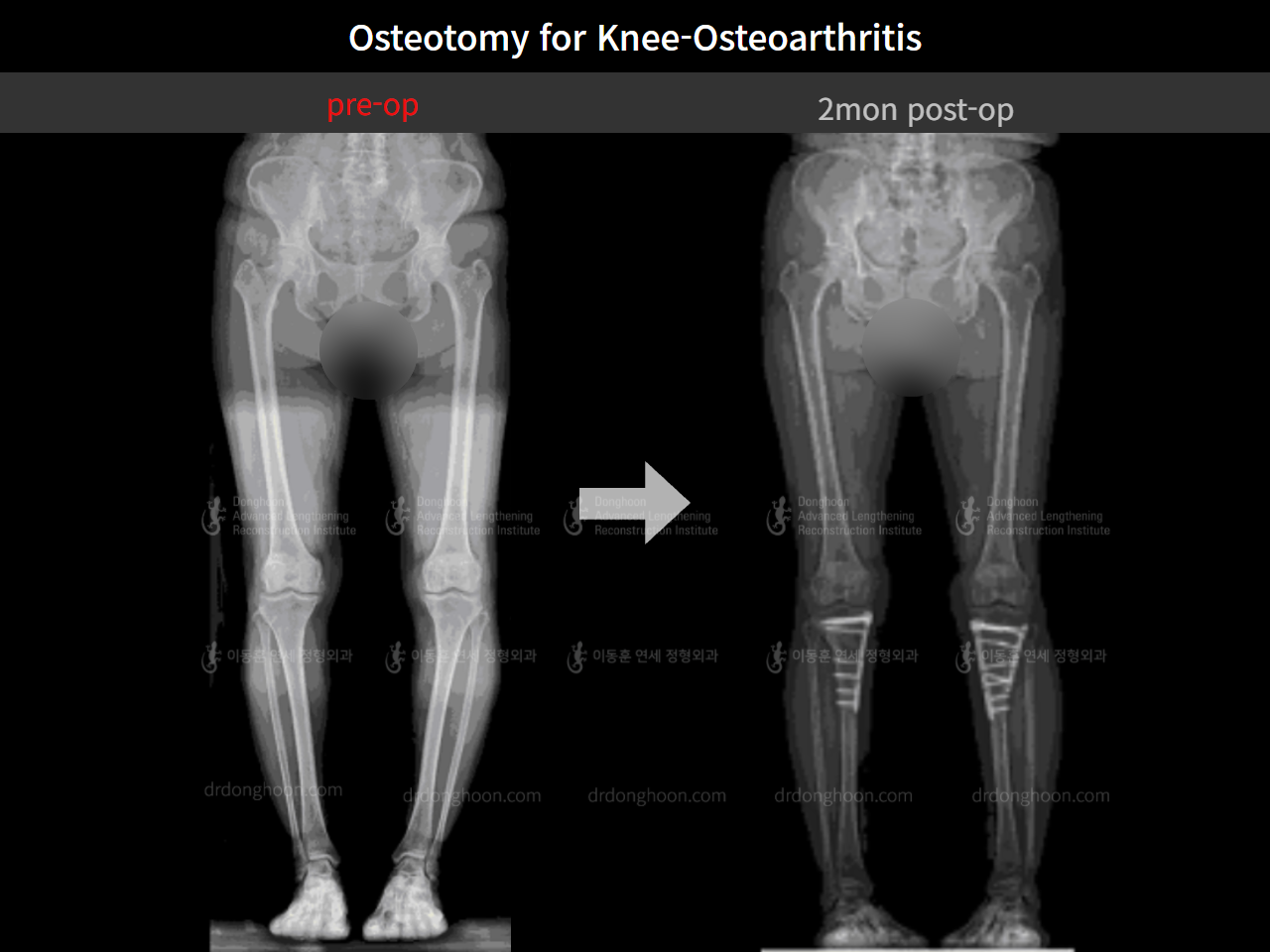 Before and after osteotomy for knee osteoarthritis, case 8826307, image 5, Dr. Donghoon institute (DALRI)