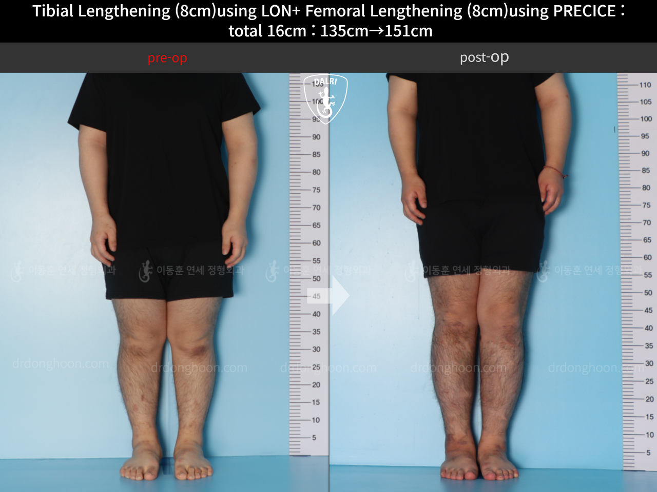 Before and after cll precice, case 12493963, image 4, Dr. Donghoon institute (DALRI)