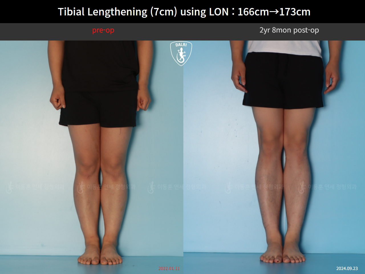 Before and after cll lon, case 127679780, image 5, Dr. Donghoon institute (DALRI)