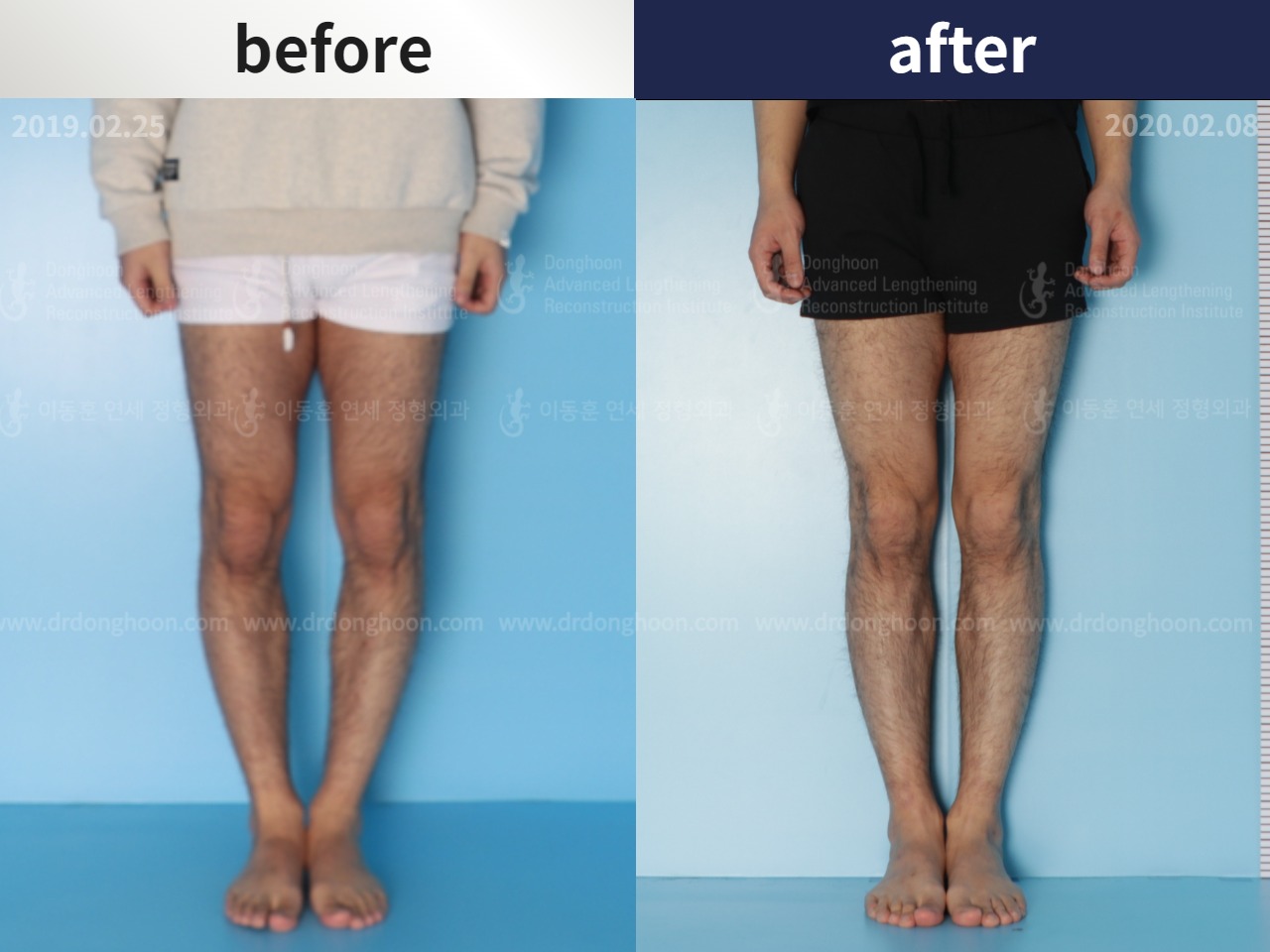 Before and after adult bowlegs, case 4586220, image 1, Dr. Donghoon institute (DALRI)