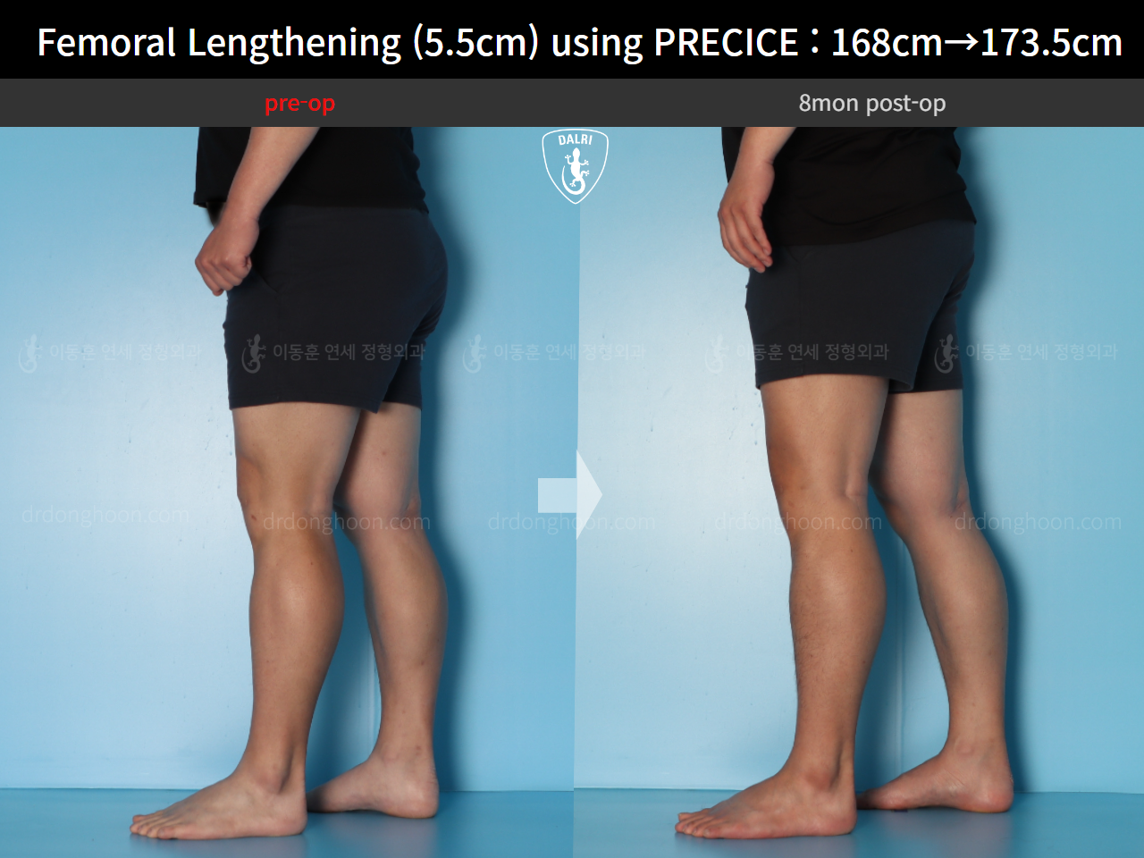 Before and after cll precice, case 16910900, image 9, Dr. Donghoon institute (DALRI)