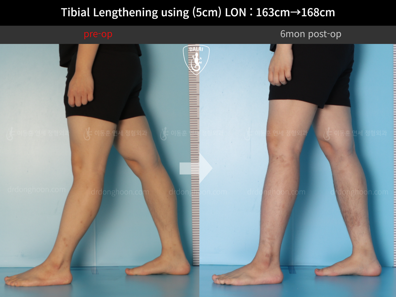 Before and after cll lon, case 12638628, image 6, Dr. Donghoon institute (DALRI)