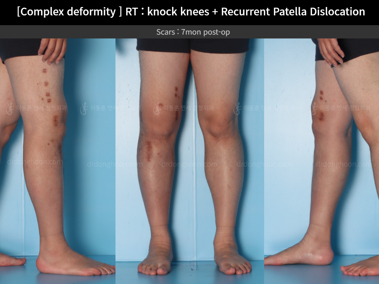 Before and after recurrent patella dislocation, case 16147031, image 11, Dr. Donghoon institute (DALRI)