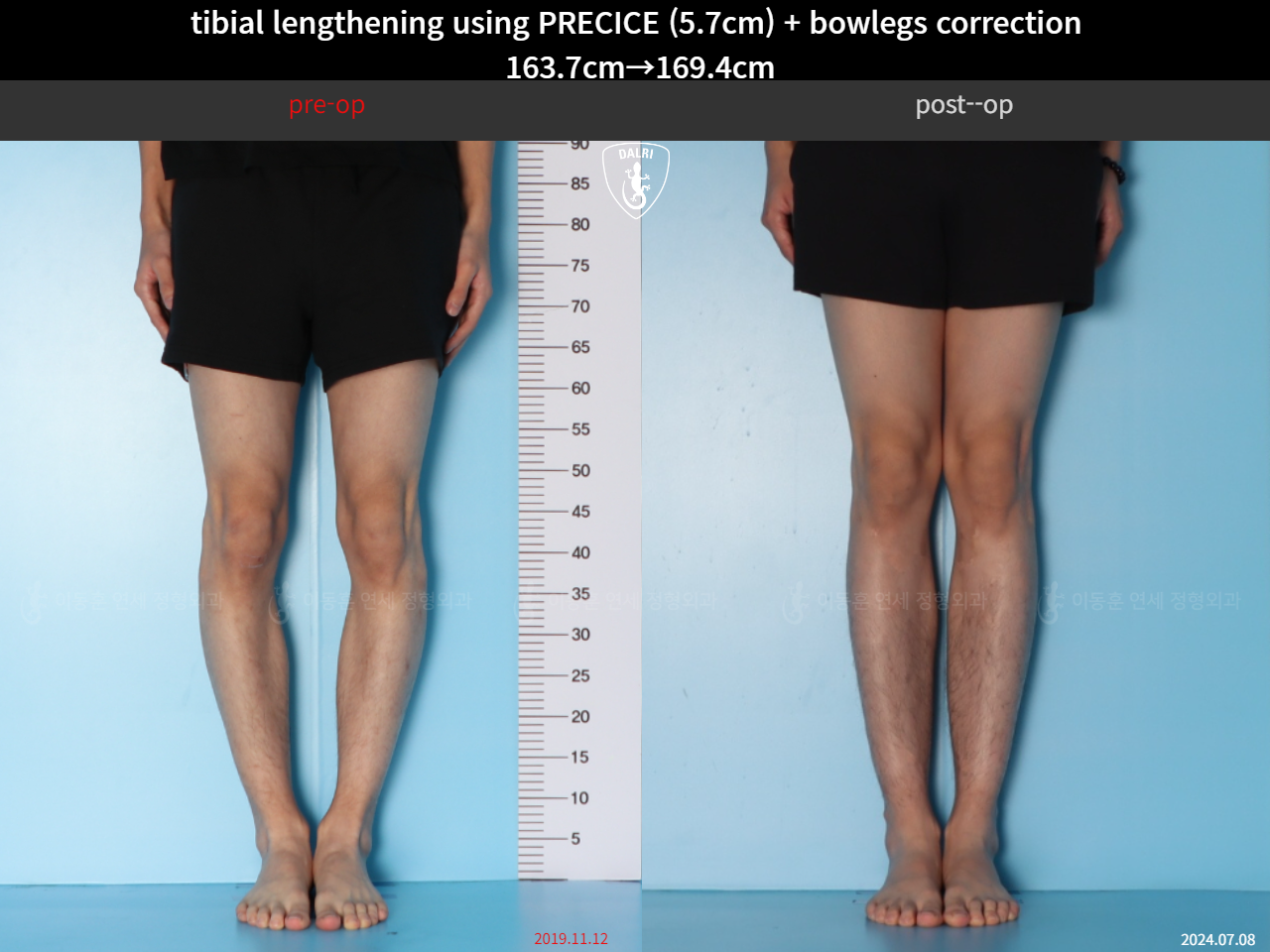 Before and after cll precice, case 38471448, image 5, Dr. Donghoon institute (DALRI)