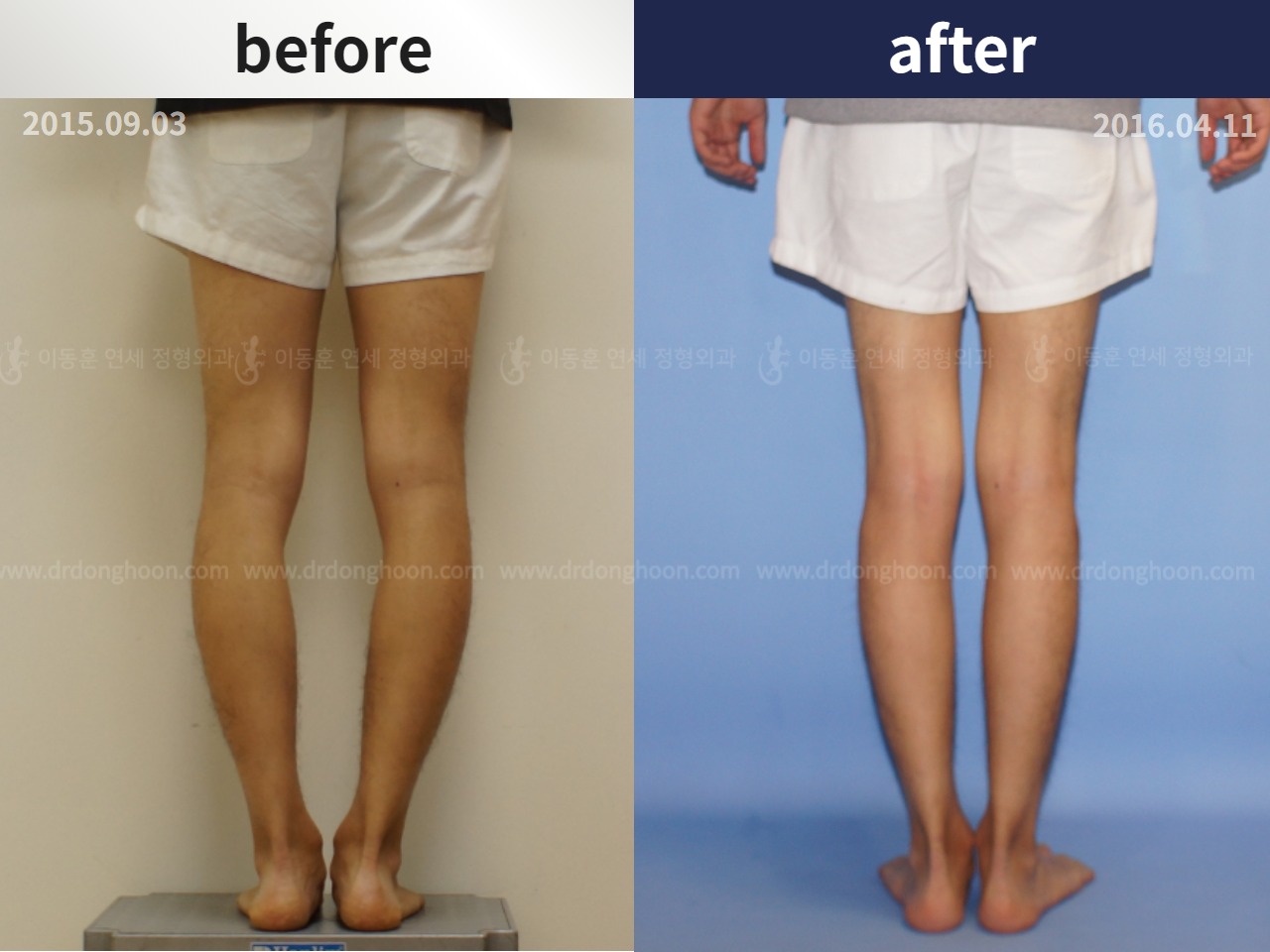 Before and after adult bowlegs, case 4311044, image 2, Dr. Donghoon institute (DALRI)