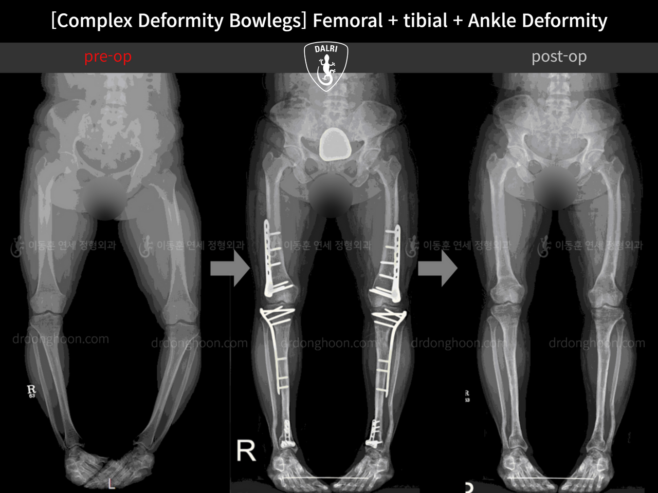 Before and after complex deformity, case 12273842, image 1, Dr. Donghoon institute (DALRI)