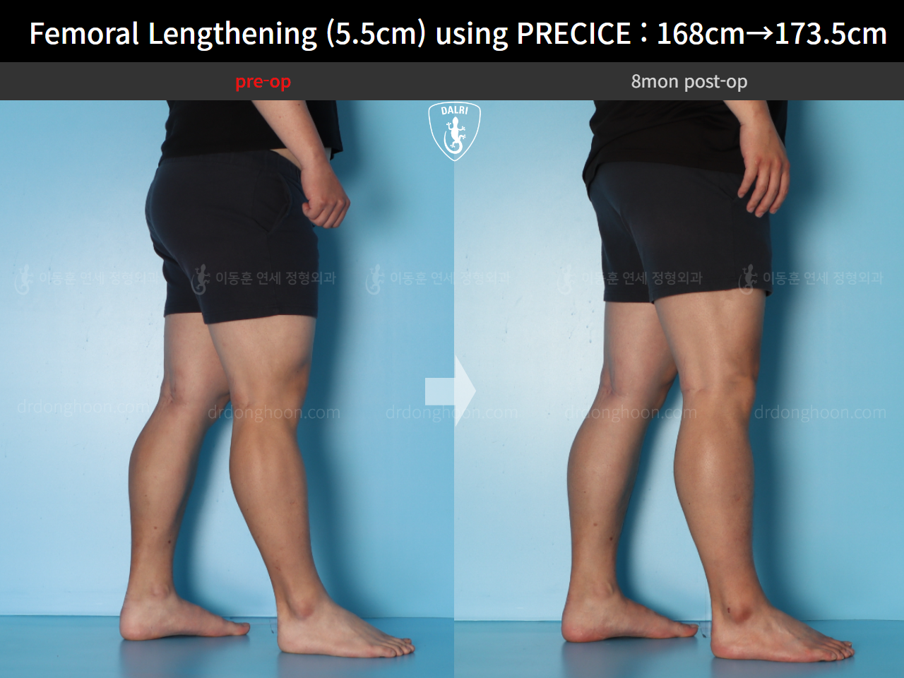 Before and after cll precice, case 16910900, image 10, Dr. Donghoon institute (DALRI)