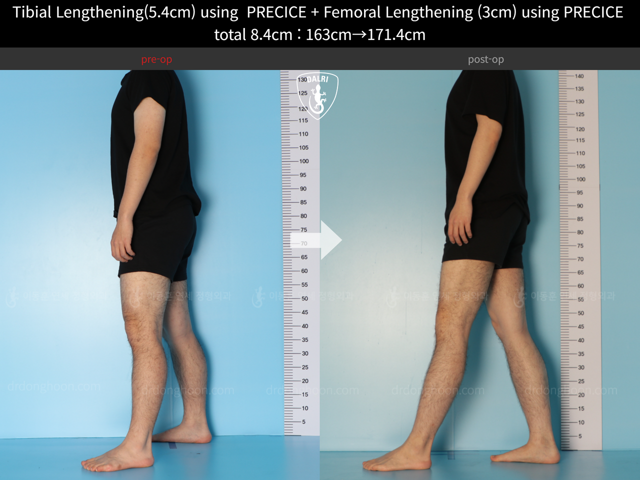 Before and after cll precice, case 12051302, image 5, Dr. Donghoon institute (DALRI)