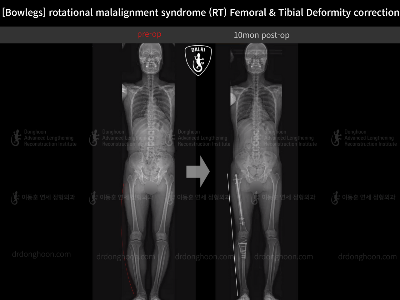 Before and after adult bowlegs, case 14220550, image 9, Dr. Donghoon institute (DALRI)