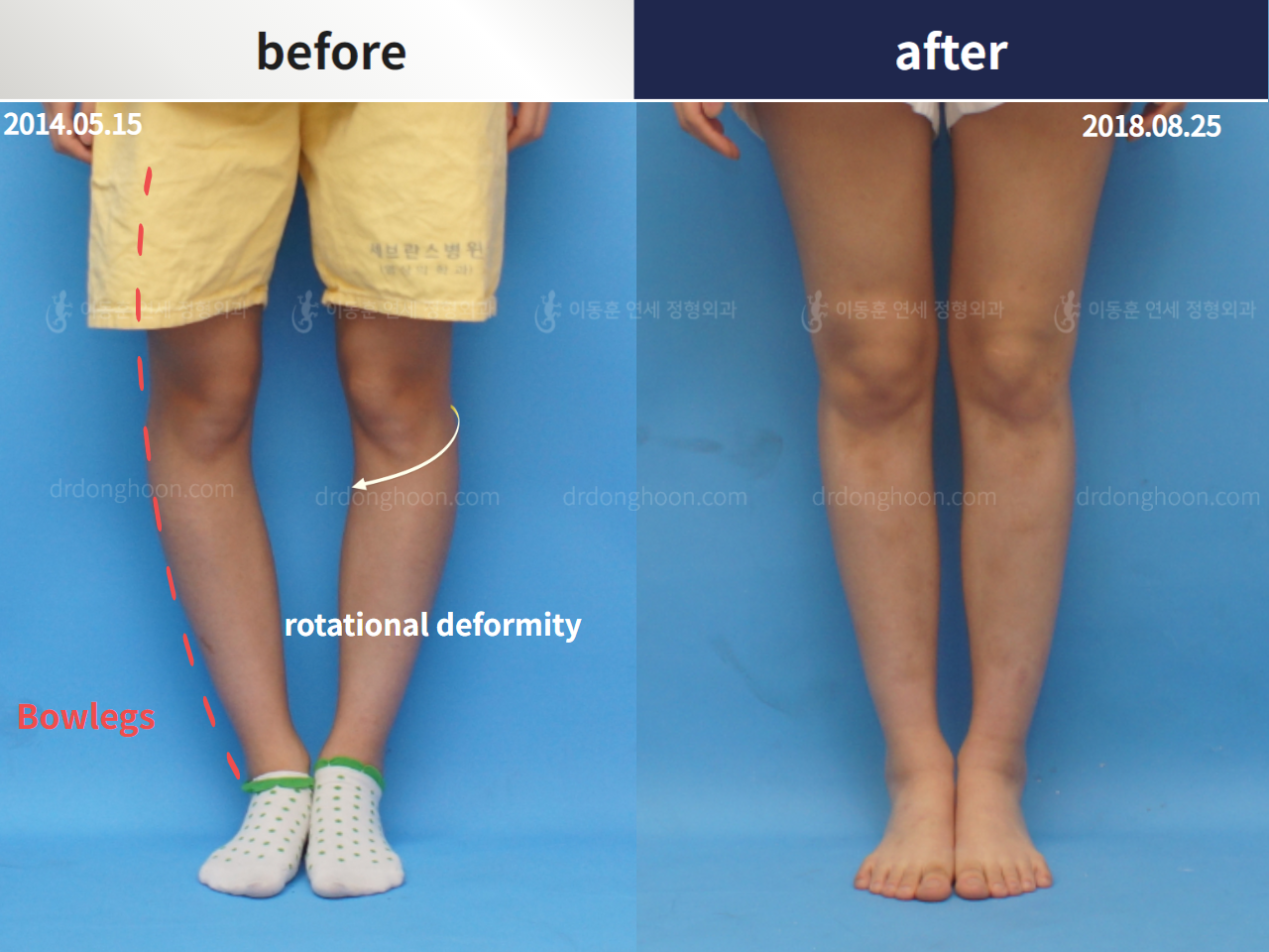 Before and after complex deformity, case 4297344, image 1, Dr. Donghoon institute (DALRI)