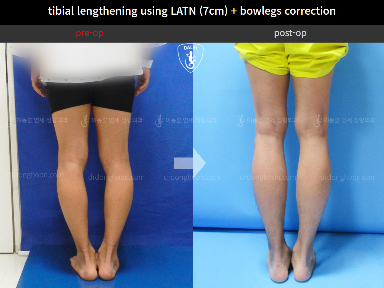 Before and after cll + deformity correction, case 4323114, image 5, Dr. Donghoon institute (DALRI)