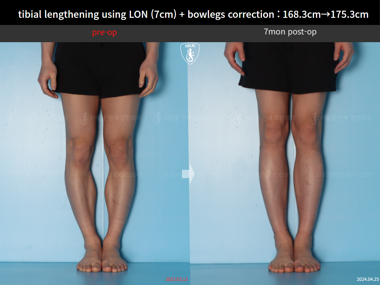 Before and after cll + deformity correction, case 21918246, image 7, Dr. Donghoon institute (DALRI)