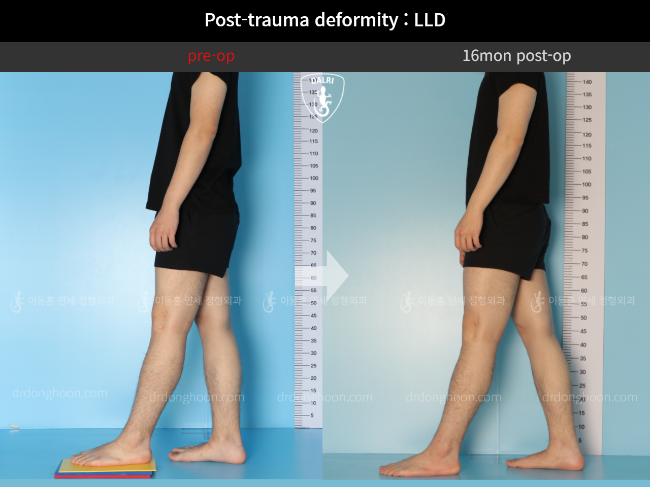 Before and after adult lld, case 11086886, image 3, Dr. Donghoon institute (DALRI)