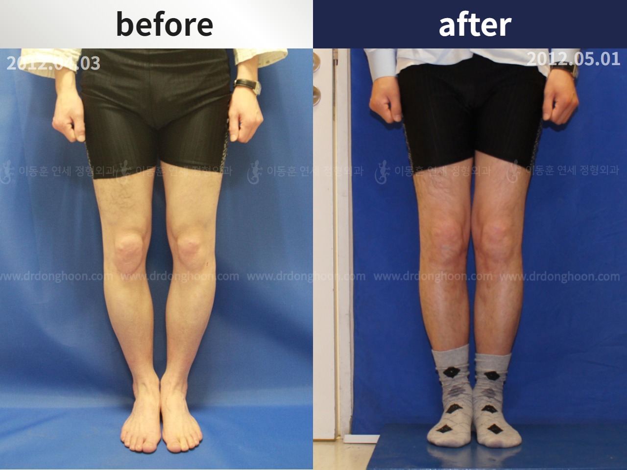 Before and after adult bowlegs, case 4311114, image 1, Dr. Donghoon institute (DALRI)